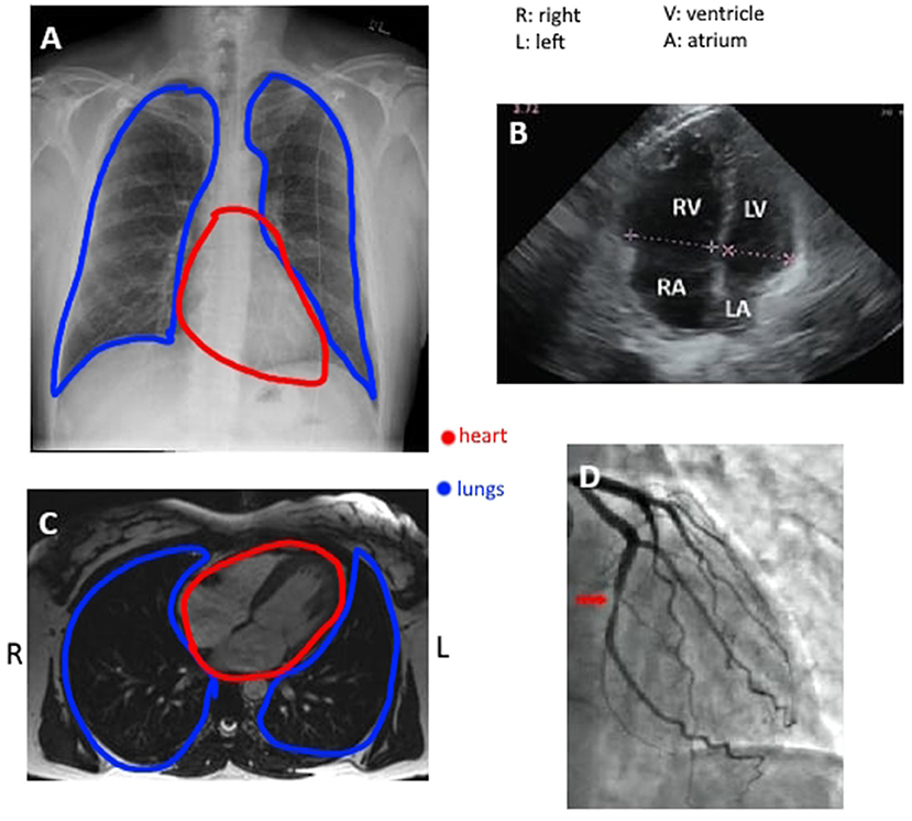 Figure 2 - (A) A standard view of the chest using an X-ray, where the heart can be seen in the center, leaning slightly to the left.