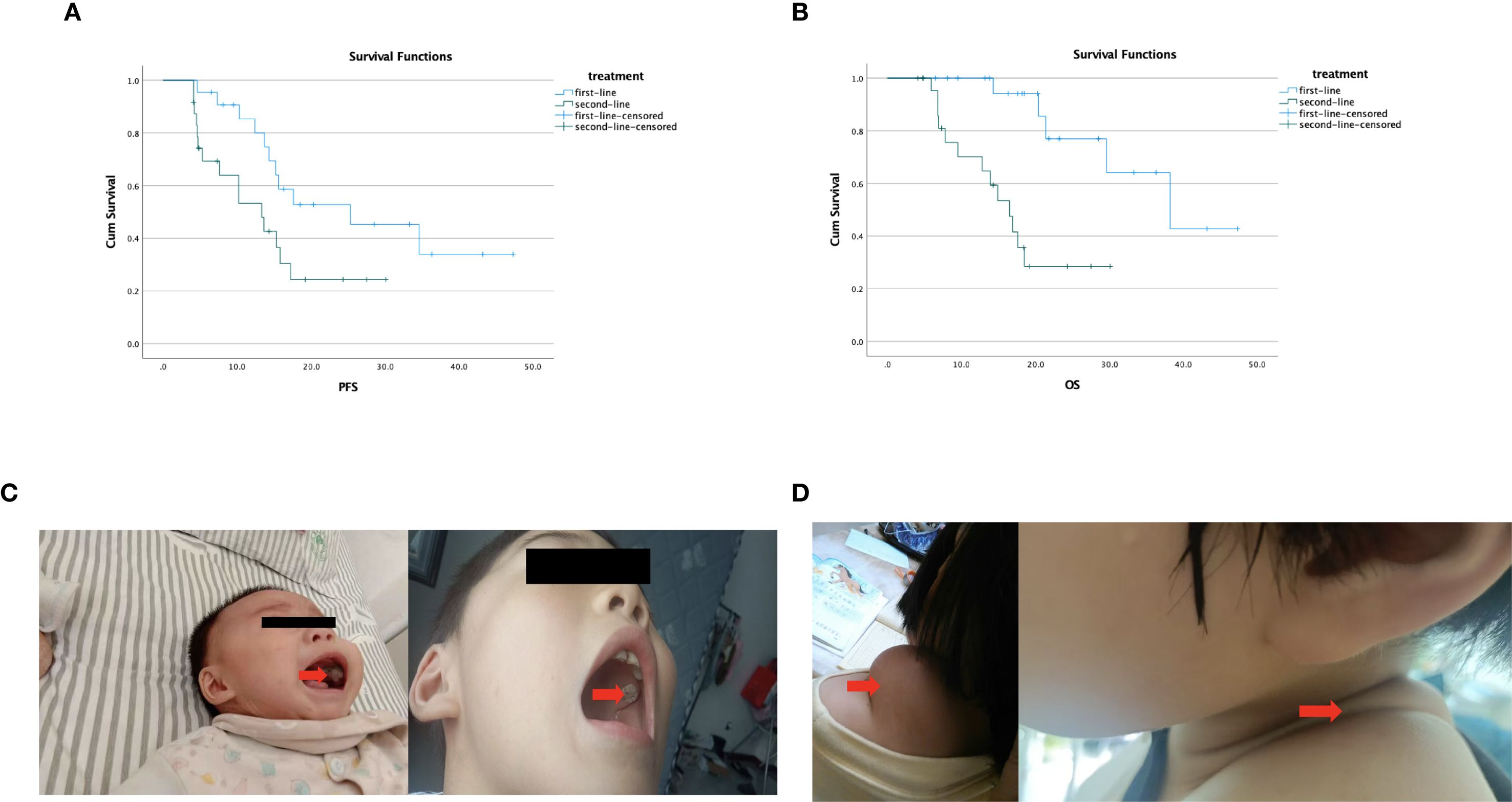 (A) Kaplan-Meier plot showing progression-free survival (PFS) for treatments with first-line and second-line therapies. (B) Kaplan-Meier plot depicting overall survival (OS) for the same treatments. (C) Two images of children with red arrows indicating specific oral health conditions and anatomical features. (D) Image of a child's shoulder with a red arrow highlighting a bodily feature.