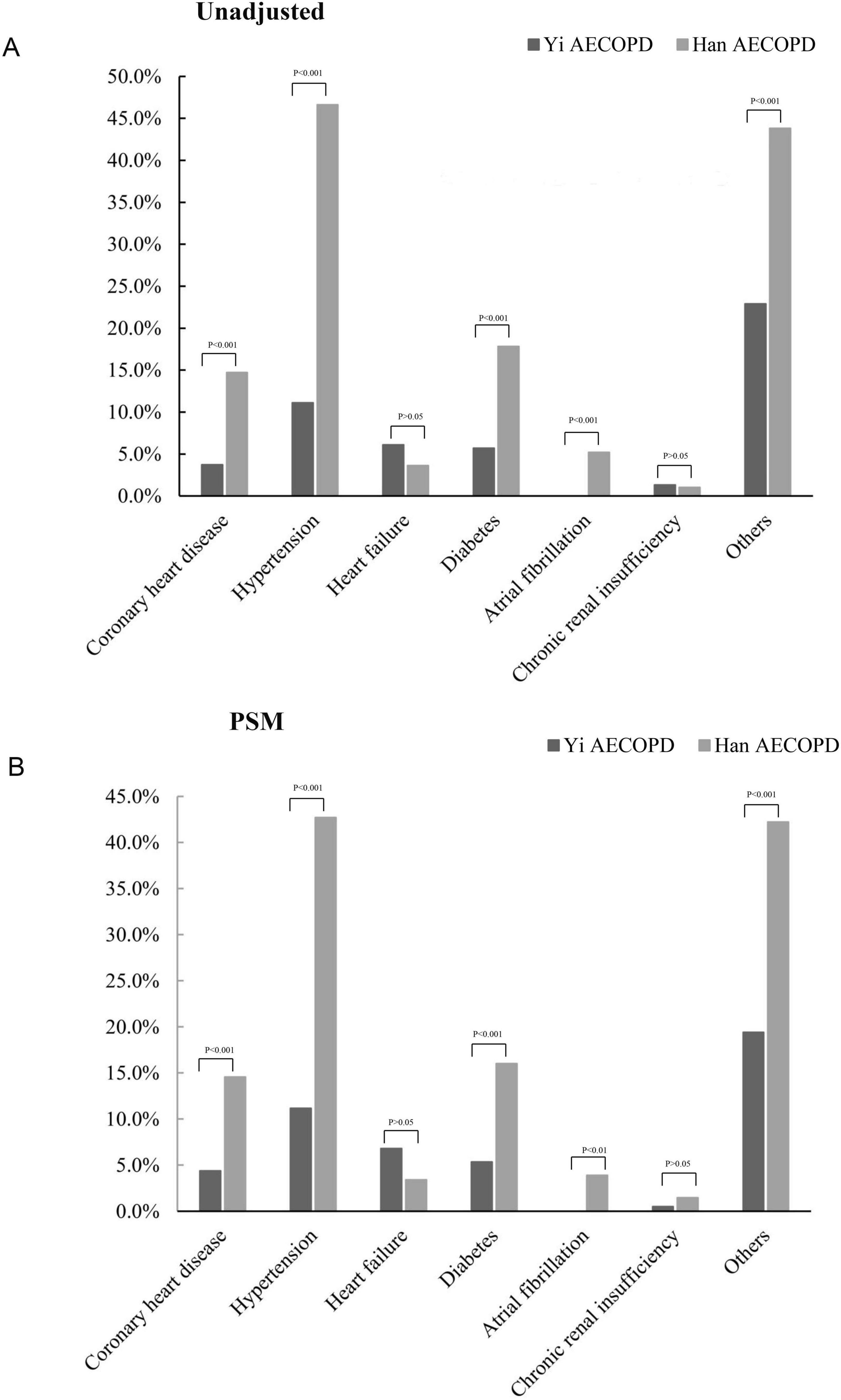 Bar charts comparing comorbidity percentages between Yi and Han AECOPD patients. Chart A is unadjusted, showing higher rates for Han in most conditions, with significant differences in coronary heart disease, hypertension, diabetes, and atrial fibrillation, and others. Chart B is post-PSM, showing similar trends with significant differences in hypertension, diabetes, atrial fibrillation, and others.