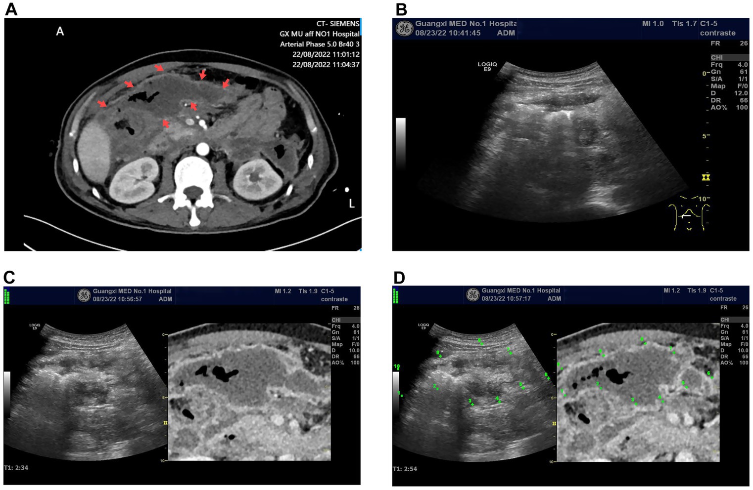 Panel A shows a CT scan with red arrows indicating specific areas. Panel B presents an ultrasound image of the abdomen. Panel C displays a side-by-side comparison of ultrasound and CT images. Panel D shows combined ultrasound and CT images with green arrows highlighting certain areas.