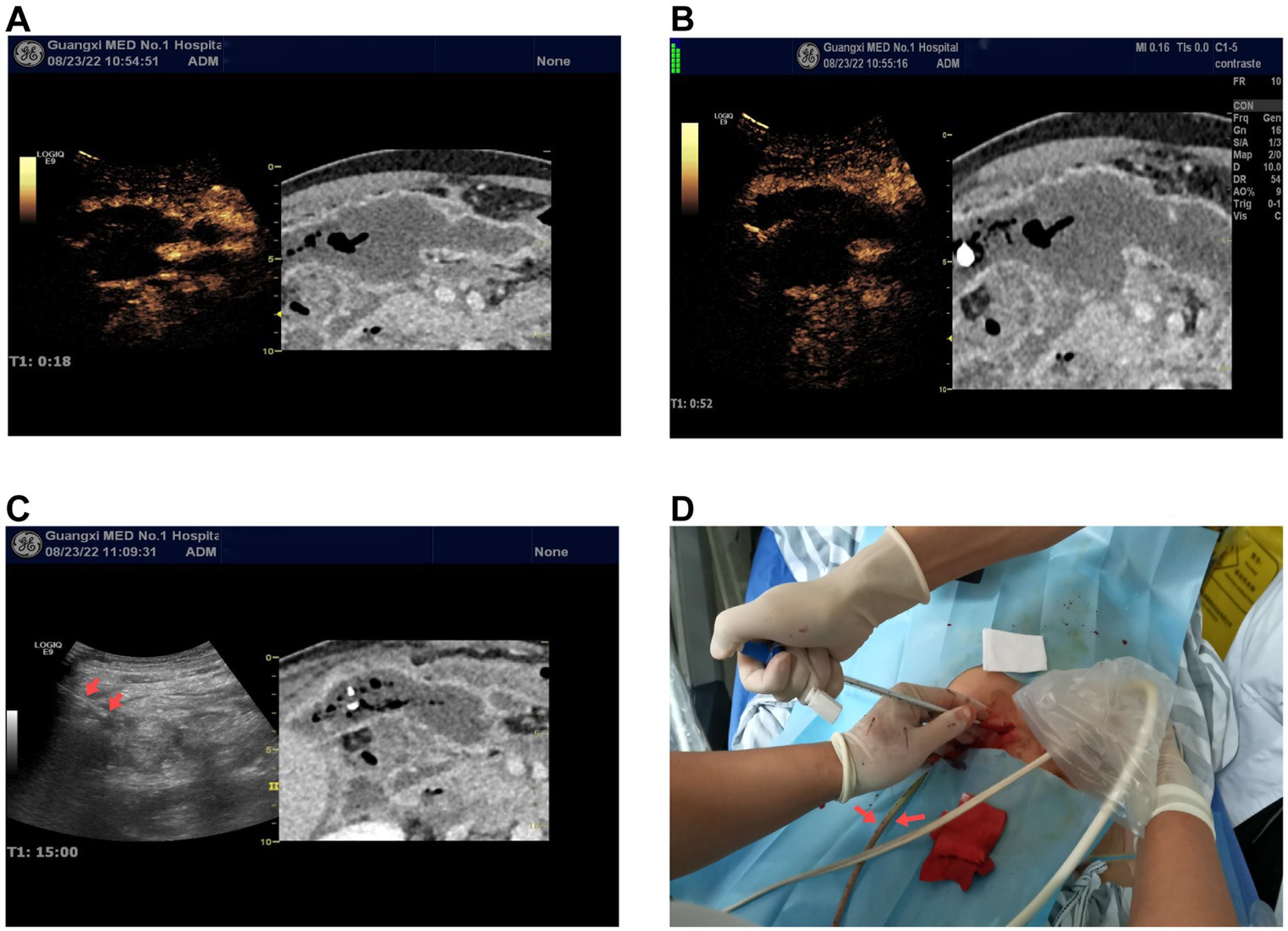 A four-panel image shows medical scans and a procedure:A: Ultrasound and CT scan of an abdominal area with black and white color contrast.B: Similar ultrasound and CT scan focusing on a specific region.C: Ultrasound with red arrows pointing to specific areas and corresponding CT image.D: Medical procedure with gloved hands inserting a tube into an incision on a patient surrounded by medical equipment.
