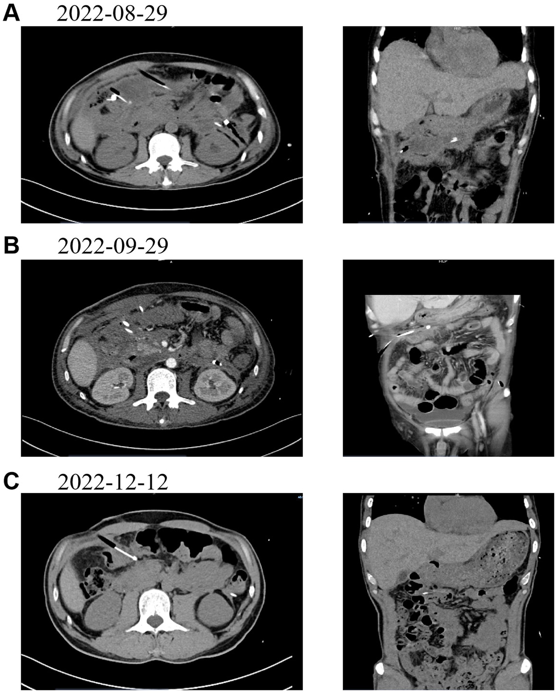 Three sets of CT scans labeled A, B, and C, dated August 29, 2022, September 29, 2022, and December 12, 2022, respectively. Each set includes an axial view on the left and a coronal view on the right. The scans show changes in internal structures over time, highlighting differences in tissue and organ visibility.