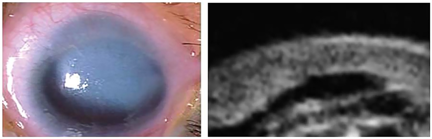 Close-up images of an eye with a bluish hue on the left, showing a detailed view of the cornea, and a black and white cross-sectional ultrasound biomicroscopy image of the eye on the right.