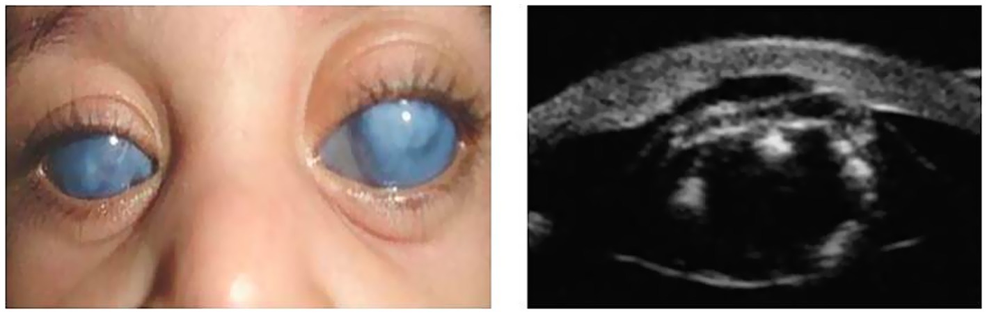 Close-up of eyes with blue corneas showing cloudy appearance on the left. On the right, a black and white ultrasound biomicroscopy image of an eye displaying internal structures.