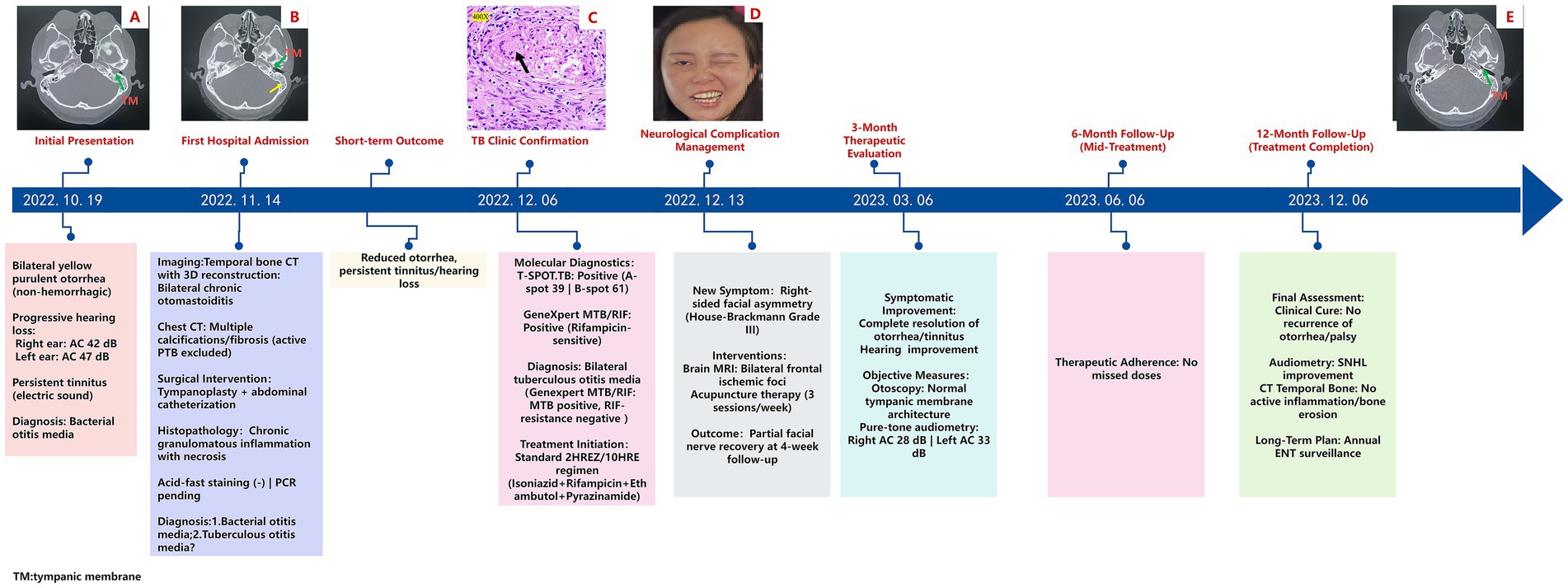 Timeline of a medical case starting from October 19, 2022, to December 6, 2023, detailing a patient's diagnosis and treatment for bilateral chronic otitis media and tuberculosis otitis media. Initial symptoms include yellow purulent otorrhea and hearing loss. Diagnostic imaging and tests confirm tuberculosis otitis. Treatment involves a standard drug regimen. Over the months, the patient shows improvement in symptoms and hearing, with therapeutic adherence noted at 6 months. The 12-month follow-up indicates clinical cure and plans for long-term ENT surveillance. Images depict CT scans and a patient.