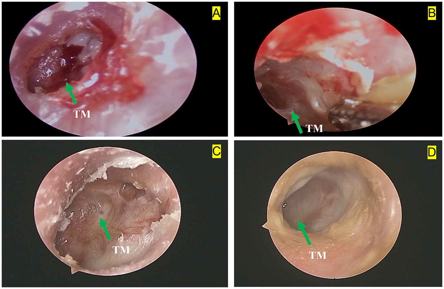 Four panels labeled A to D show tympanic membranes at varying stages of healing. Each image is marked with a green arrow pointing to the membrane labeled