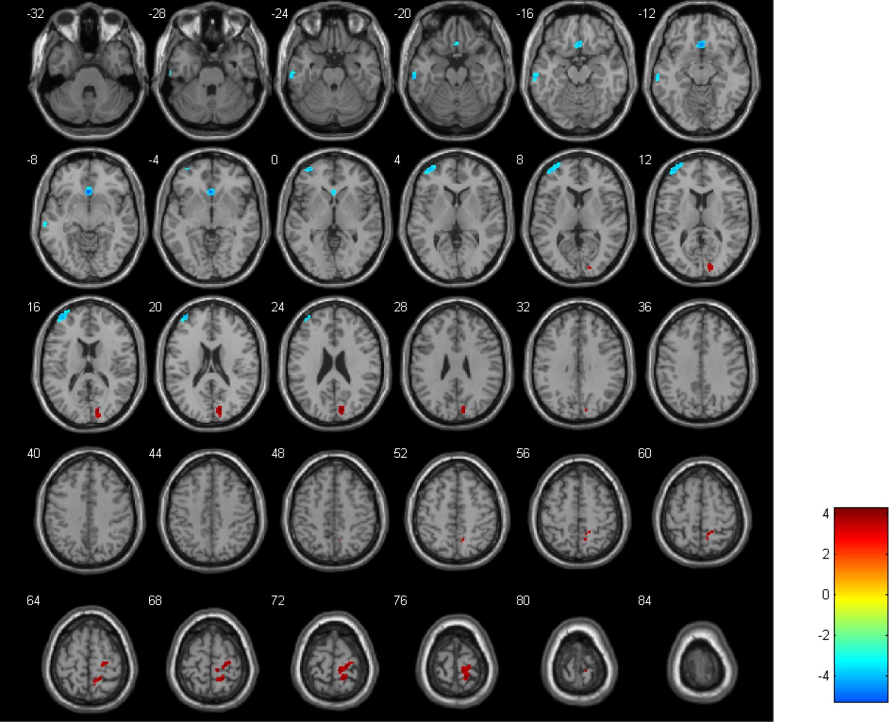 MRI brain scans in axial sections displaying various levels. Blue and red markers highlight specific regions of interest. A color scale on the right ranges from blue to red, labeled from negative four to four.