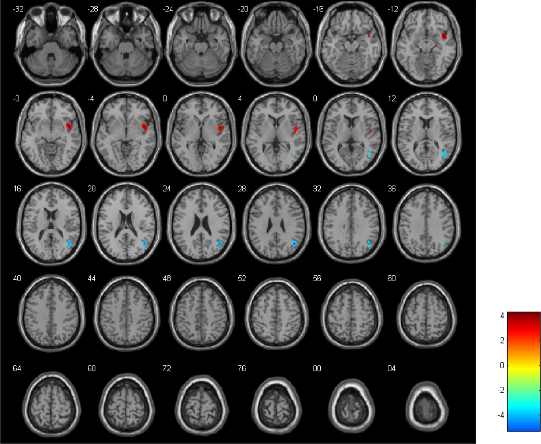 MRI brain scans in axial view at various slice levels display regions marked in red and blue. Numbers on each image indicate slice positions. A color scale to the right ranges from red to blue.