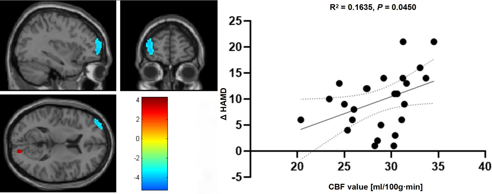 Brain imaging scans show highlighted regions in blue on three different planes, indicating areas of interest. A color scale beside the images ranges from red to blue. To the right, a scatter plot correlates cerebral blood flow (CBF) values with changes in Hamilton Depression Rating Scale (HAMD) scores. The plot includes a trend line, with R² value of 0.1635 and a p-value of 0.0450, suggesting a weak positive correlation.