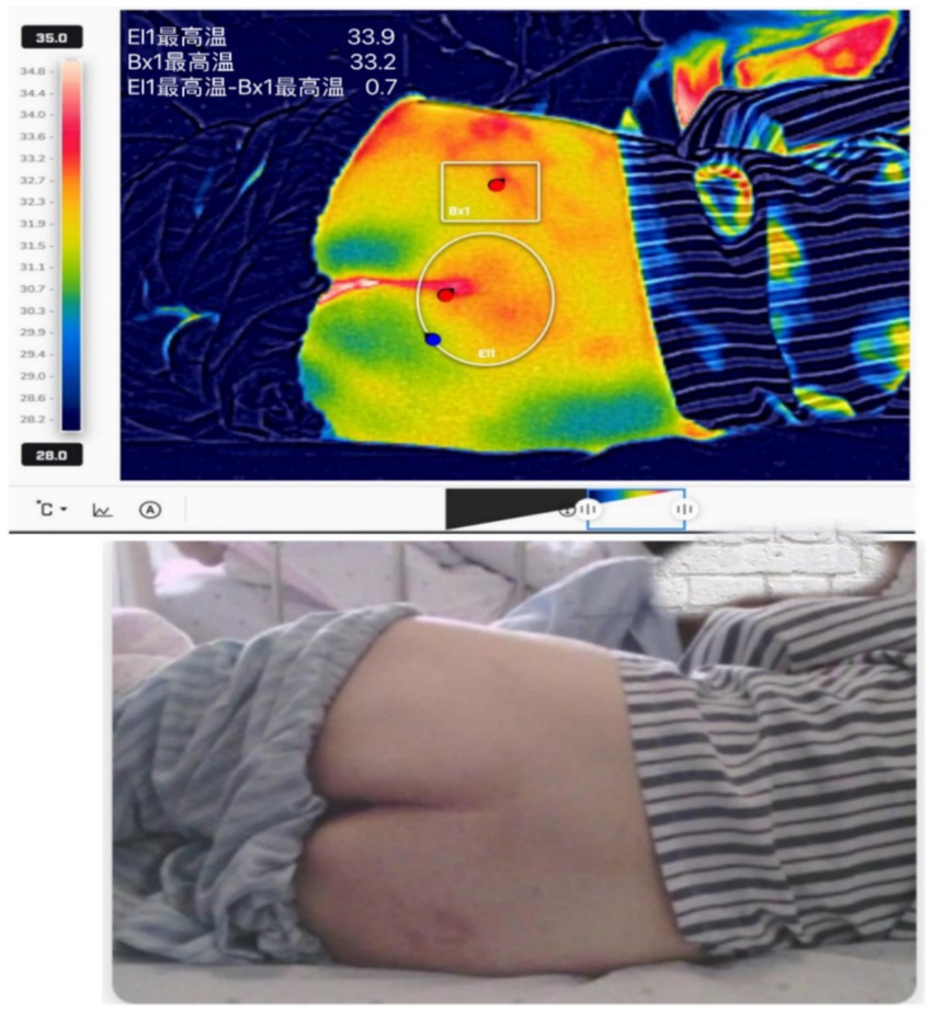 Thermal imaging of a person's lower back shows temperature variations with areas marked Bx1 and E1. The highest temperatures are 33.9°C and 33.2°C respectively. Below, a photograph of the same area shows a person lying on their side, covered partially with a striped fabric, and a visible skin mark.