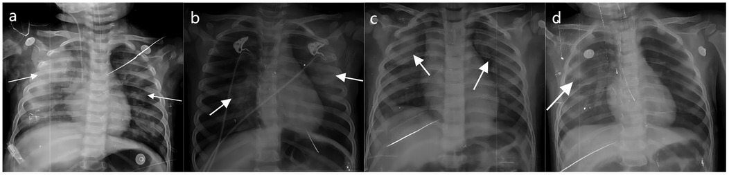 Chest X-rays in four panels labeled a, b, c, and d. The panel shows different degrees of NPE in children with HFMD, indicated by arrows. The X-rays reveal the thoracic cavity including ribs, spine, and heart shadow.