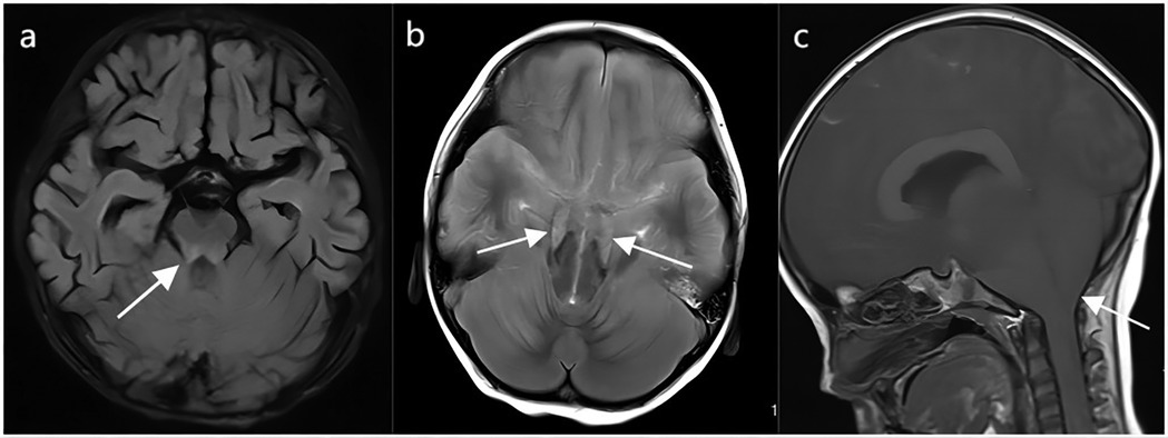 MRI brain scans of three children with HFMD. Image (a) demonstrates brainstem encephalitis. Image (b) shows tentorial hernia. Image (c) reveals cerebellotonsillar hernia. Pathological features are indicated by arrows.