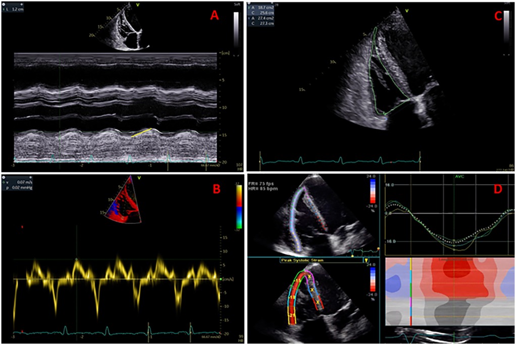 Panel A shows a grayscale echocardiogram in M-mode. Panel B displays tissue doppler imaging of the RV free wall. Panel C features a 2D echocardiogram with tracing of the endocardium of the RV. Panel D includes strain imaging with graphical analysis of the RV.