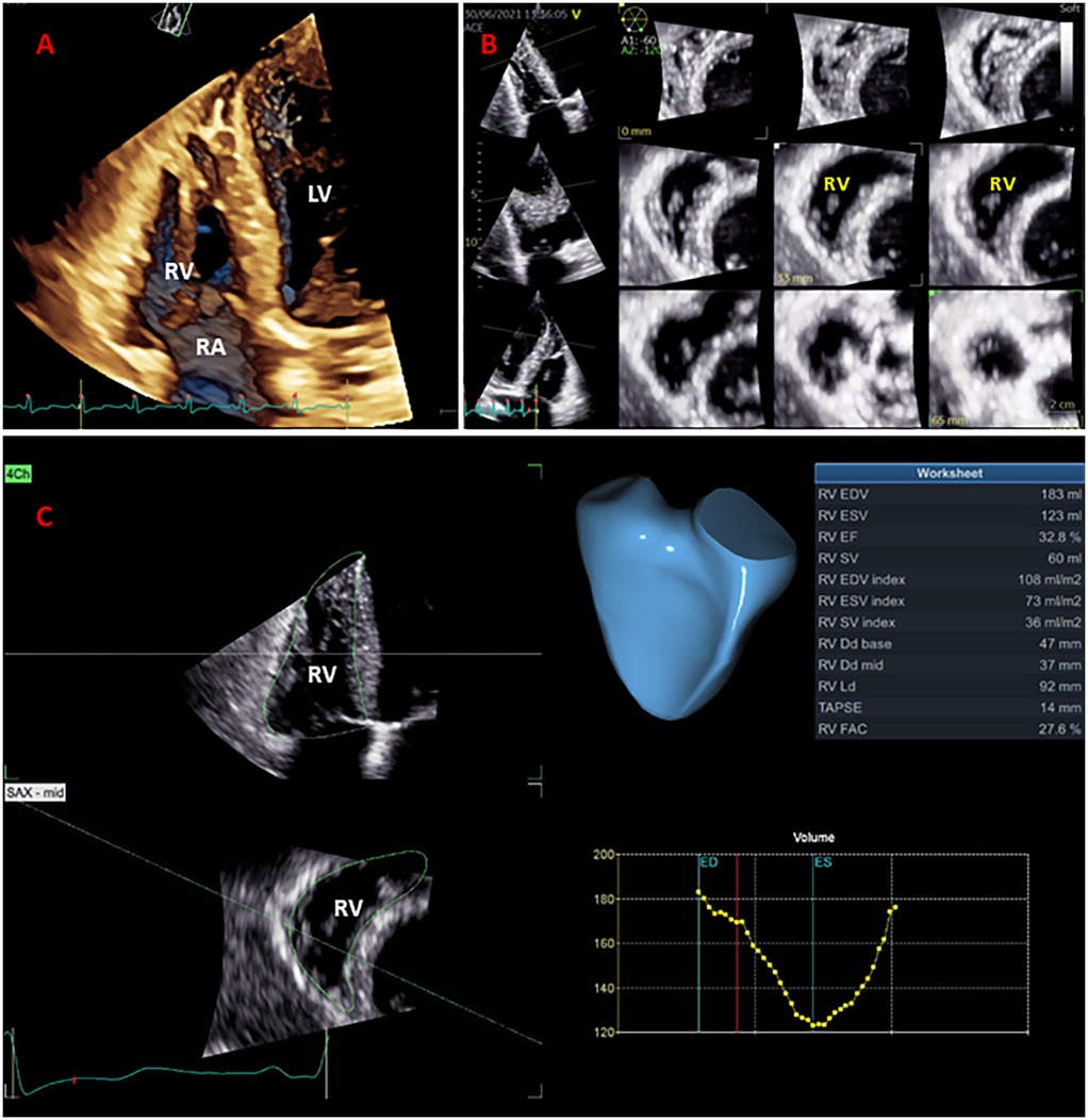 Three-dimensional ultrasound images of the heart segmented into labelled sections, RV (right ventricle), RA (right atrium), and LV (left ventricle). Panel A shows a 3D echocardiography full-volume of the RV. Panel B displays multiple 2D echocardiography cross-sectional images of the RV, and Panel C presents a 3D RV model with a corresponding data table. A graph depicting RV volume data is included.