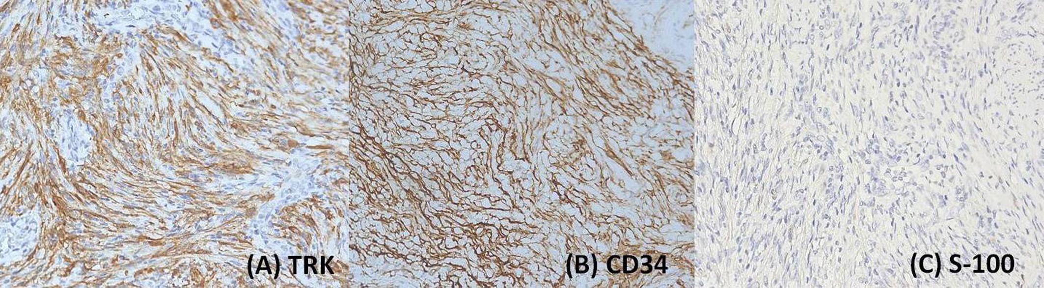 Histological images showing three immunohistochemistry stains. Panel (A) shows TRK with brown staining in fibrous tissue. Panel (B) displays CD34 with brown-stained fibrous networks. Panel (C) shows S-100 with mostly unstained tissue and dispersed nuclei.