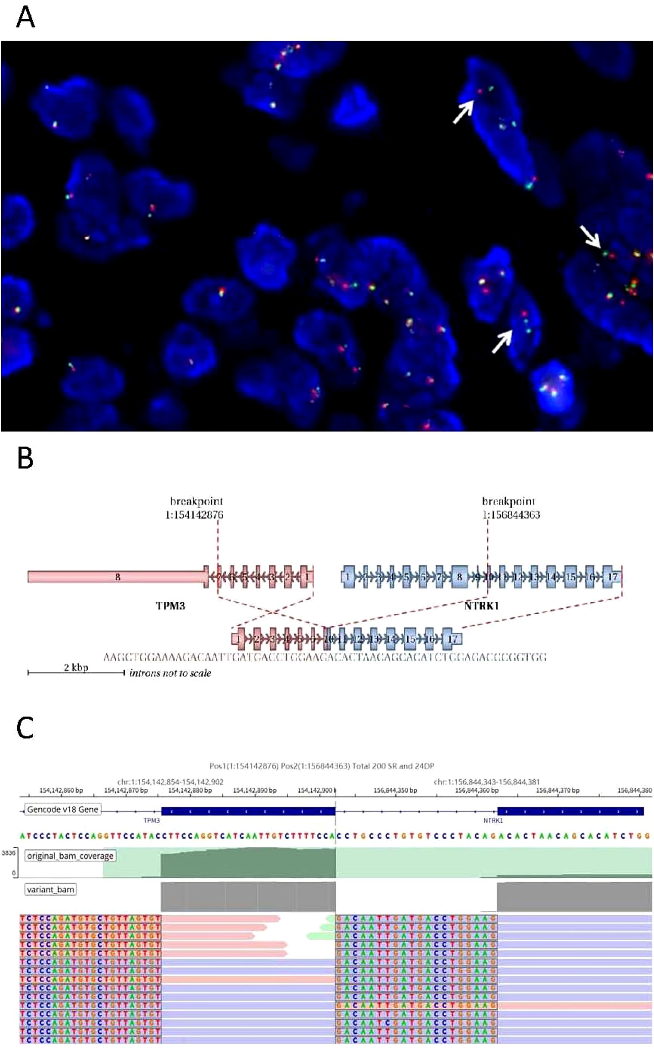 A. Fluorescence in situ hybridization image showing blue-stained nuclei with distinct red and green signals, some indicated by arrows. B. Diagram illustrating the gene fusion breakpoint between TPM3 and NTRK1 genes, with DNA segments and breakpoints labeled. C. Sequence alignment showing TPM3-NTRK1 fusion, with gene positions, sequence reads, and alignment data visually represented.