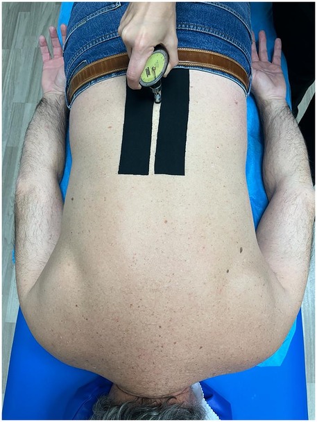 A diagram showing the placement of the transcutaneous magnetic patch (TMP) and the placebo tape on the lumbar spine. Both tapes appear visually identical.