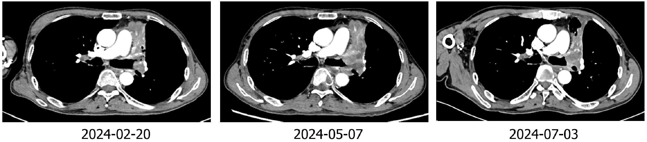 Three CT scan slices showing chest cross-sections on different dates: February 20, 2024; May 7, 2024; and July 3, 2024. Each image shows anatomical structures for medical analysis.