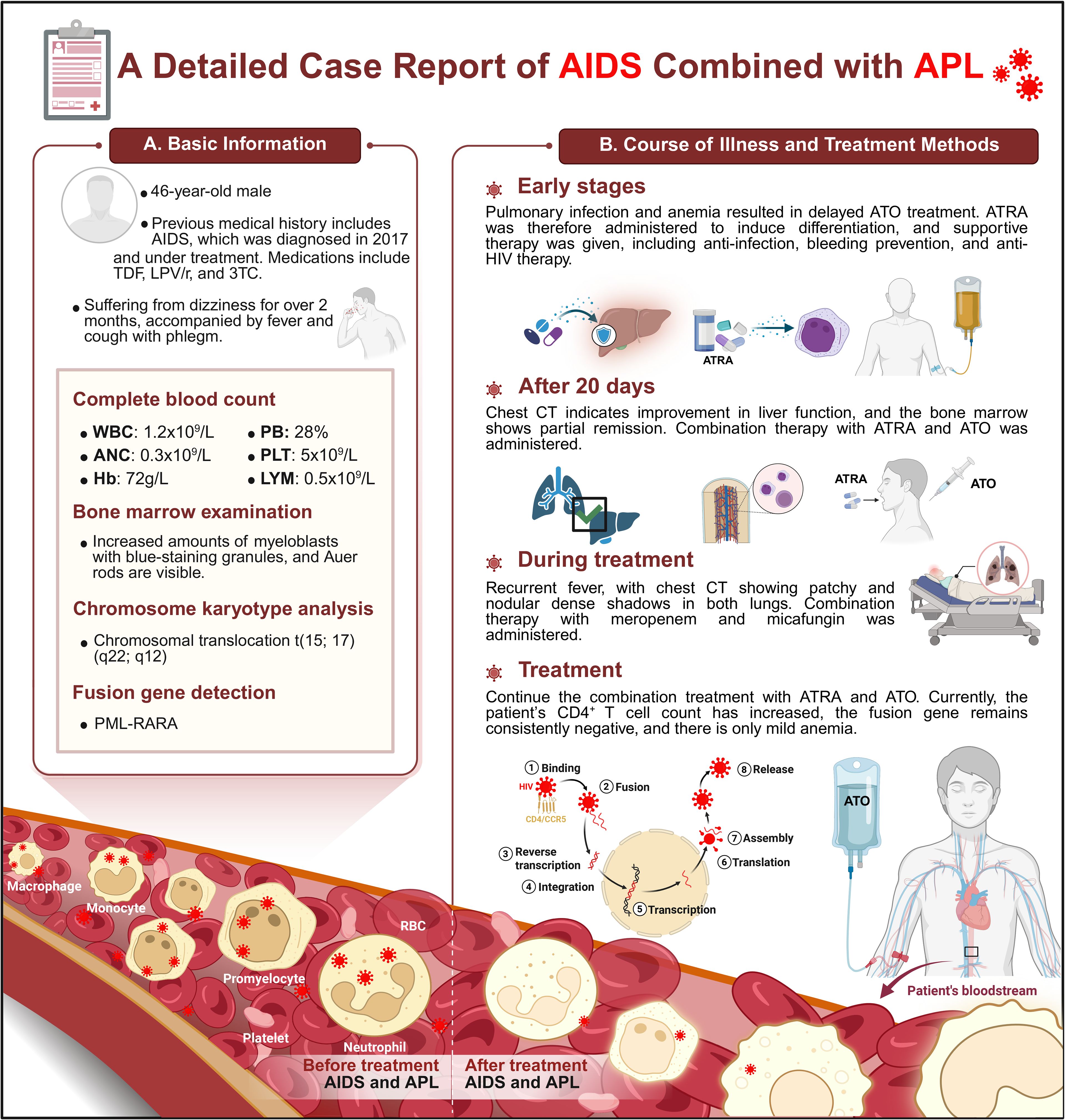 Case report infographic detailing AIDS combined with acute promyelocytic leukemia (APL). It includes sections on patient information and treatment progression. Early stages show delayed ATO treatment due to infections; ATRA is administered. After 20 days, partial remission is noted. During treatment, recurrence occurs, and additional medication is used. Treatment continues with ATRA and ATO, resulting in increased CD4+ T cell count. Illustrated blood cells at the bottom depict changes before and after treatment, with visual aids for cell processes and treatment effects.