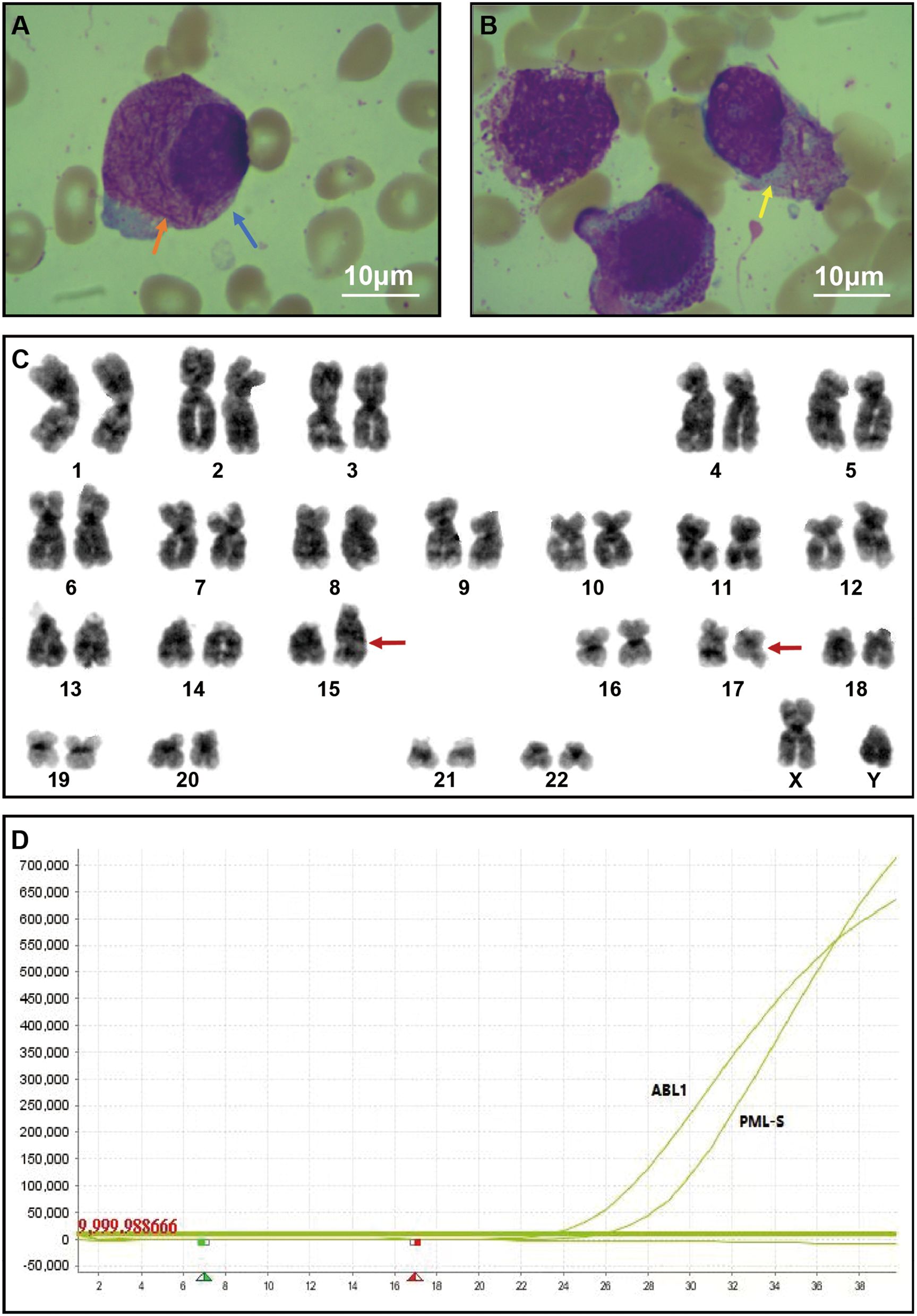 Microscope images and graphs illustrating cellular and chromosomal structures. Panel A shows a purple-stained cell with orange and blue arrows. Panel B has two purple-stained cells with a yellow arrow. Panel C displays chromosomes labeled one through twenty-two, X, and Y, with arrows pointing at chromosomes fifteen and seventeen. Panel D is a graph with y-axis labeled from negative fifty thousand to seven hundred thousand and x-axis labeled with numbers two through thirty-eight. Two curves labeled ABL1 and PML-S are shown, with data points marked along the x-axis.
