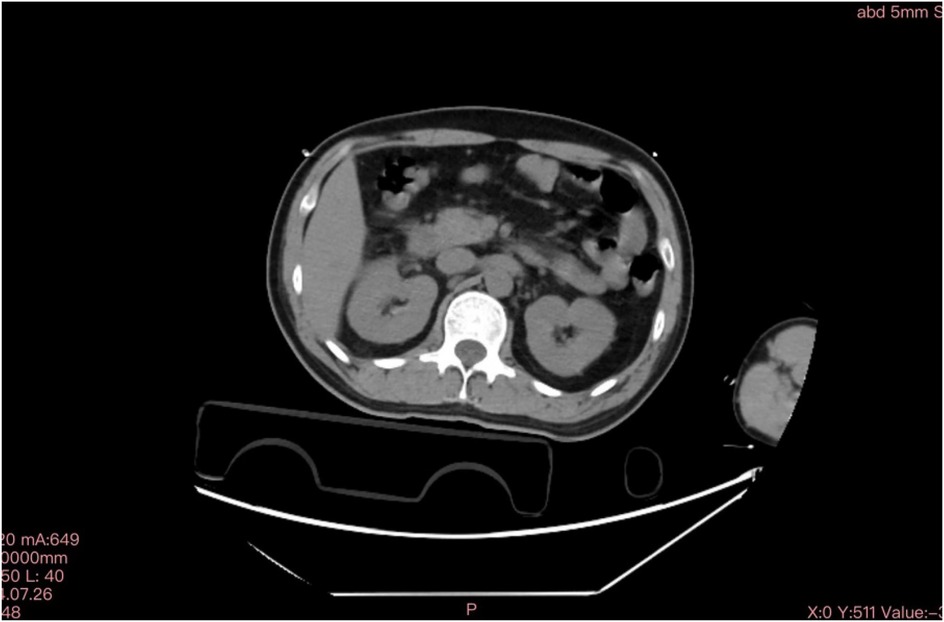 CT scan of the abdomen showing a cross-sectional view of internal organs, including the spine and possibly both kidneys, surrounded by varying shades of gray representing different tissue densities.
