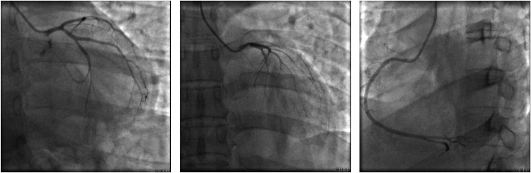 Three x-ray images showing coronary angiograms. The first image displays the left coronary artery, the second highlights a different angle of the same artery, and the third shows the right coronary artery.