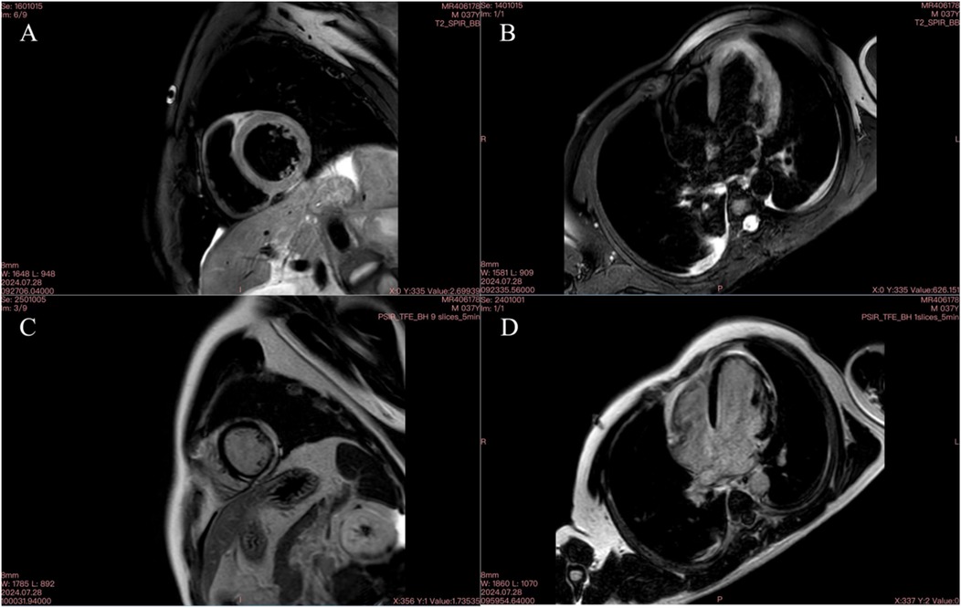 MRI images displaying different cross-sectional views of the chest. Panel A shows a detailed view of a circular structure, likely a blood vessel. Panel B reveals a broader view, highlighting various thoracic structures. Panel C appears similar to Panel A with subtle differences in surrounding tissue. Panel D provides a clear view of the heart chambers. All images are in grayscale, focusing on internal anatomical features.