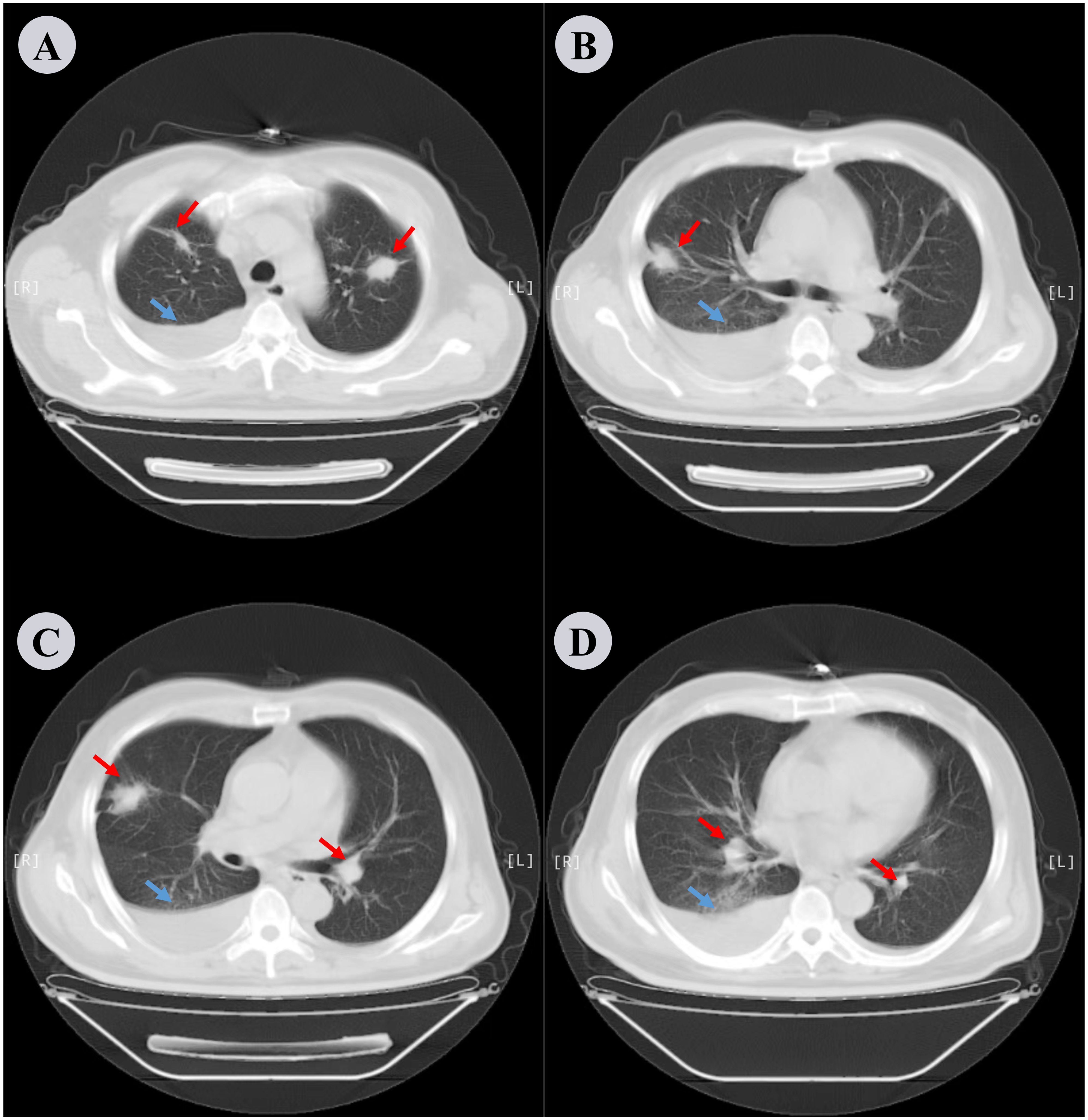 CT scan images in four panels labeled A, B, C, and D, showing cross-sections of the lungs. Red arrows indicate areas of interest, possibly lesions or abnormalities, in different lung regions. Blue arrows highlight additional points, possibly for comparison. Each panel displays different axial slices of the thoracic cavity.