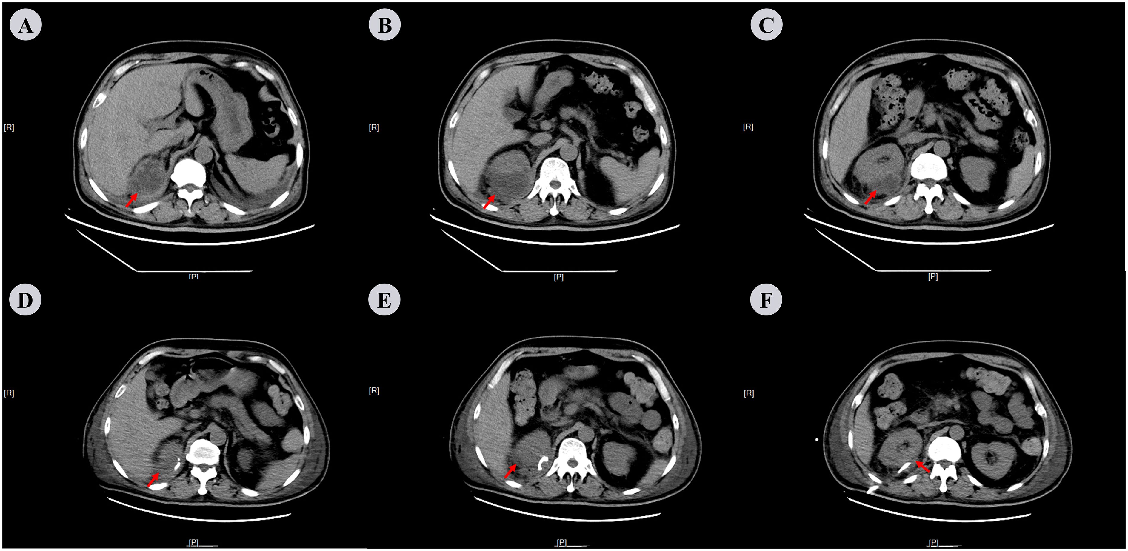 Six-panel medical imaging showing abdominal CT scans labeled A to F. Each image highlights a different area with a red arrow, indicating points of interest likely related to anatomical findings or pathology, positioned near the spine and surrounding organs within the abdominal cavity.