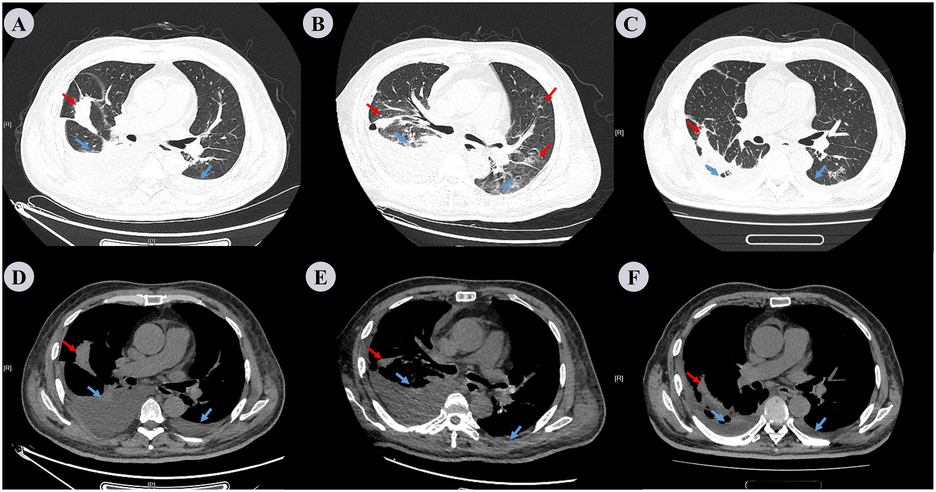 Six-panel CT scan images labeled A to F display lung and chest cross-sections. Red arrows indicate areas of significant finding, while blue arrows point to other notable areas. Each panel shows variations in contrast and markings within the chest cavity.