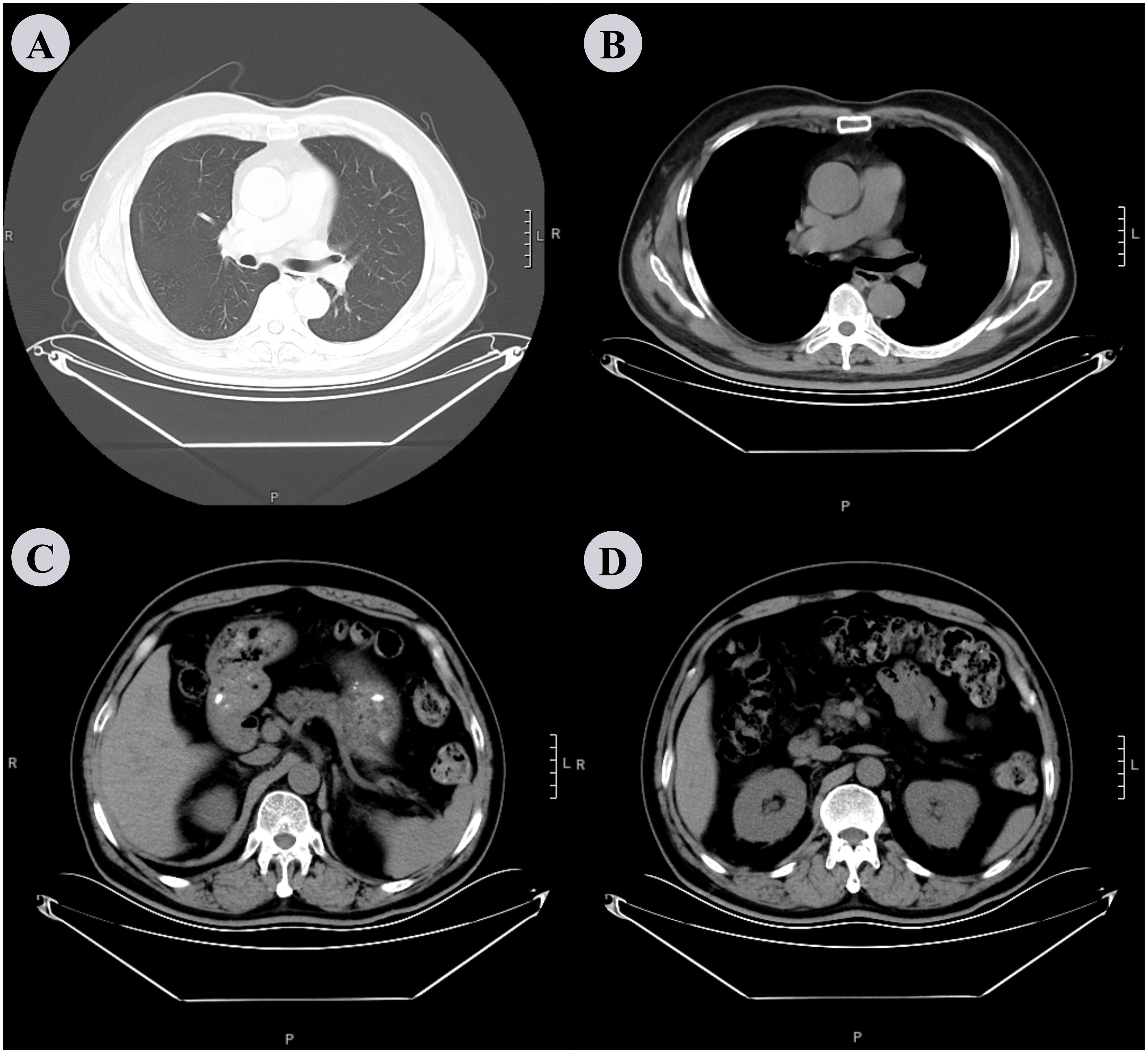CT scan images labeled A, B, C, and D. A shows a cross-section of the chest, displaying lungs and heart. B depicts a contrast-enhanced chest section. C and D illustrate abdominal sections, highlighting organs such as the liver and intestines.