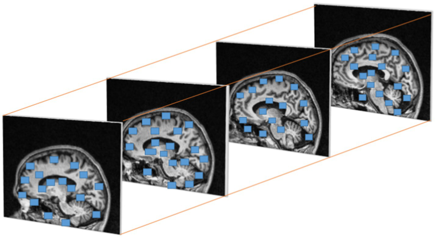 MRI brain scans are shown in a sequence, with blue overlays highlighting specific areas of interest in each scan. The images are arranged in a 3D perspective.