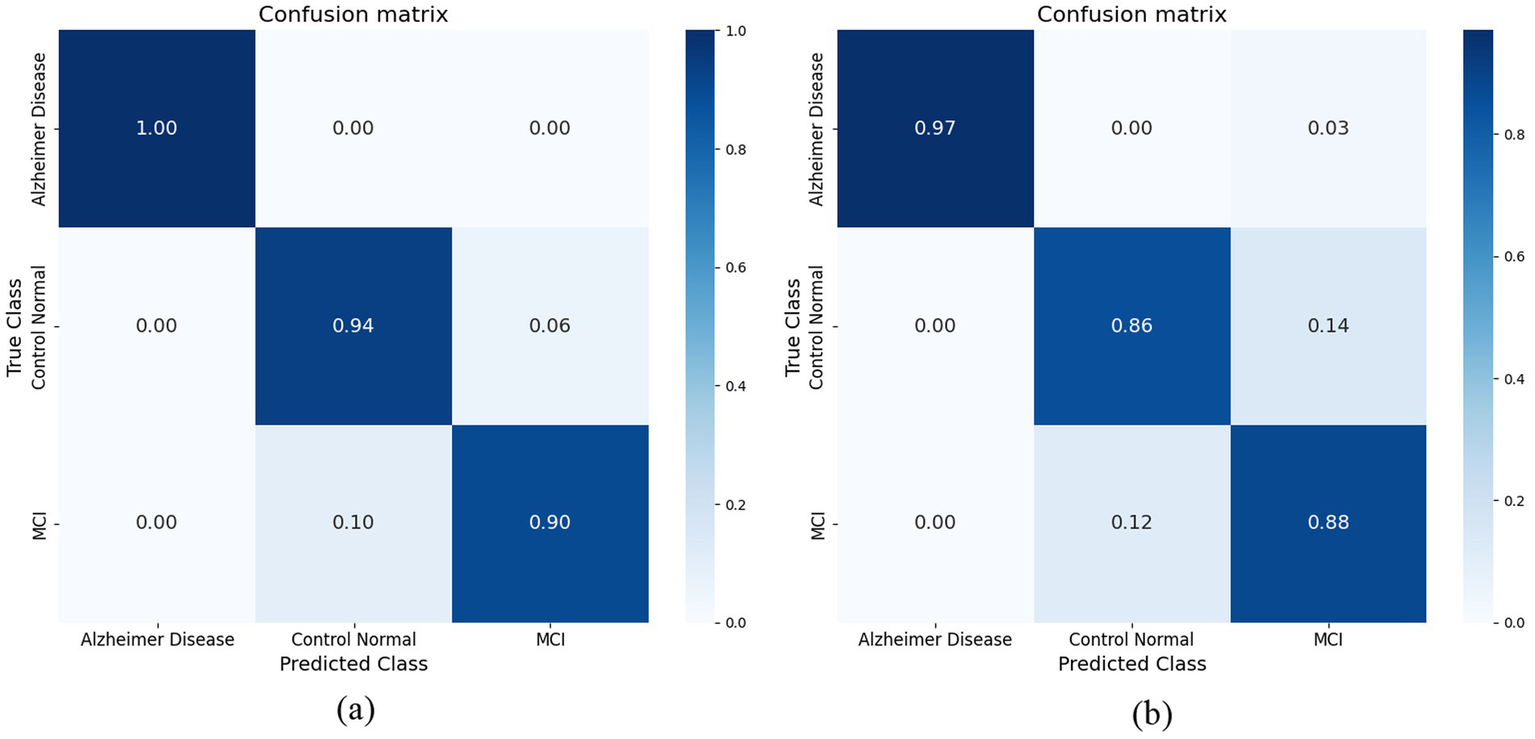 Two confusion matrices comparing predictions for Alzheimer Disease, Control Normal, and Mild Cognitive Impairment (MCI). Matrix (a) shows perfect Alzheimer predictions and high accuracy for Control Normal and MCI. Matrix (b) shows slight reduction in accuracy, particularly in Alzheimer predictions and a slight increase in misclassification between Control Normal and MCI. Both matrices use a color gradient from light to dark blue representing increasing accuracy.