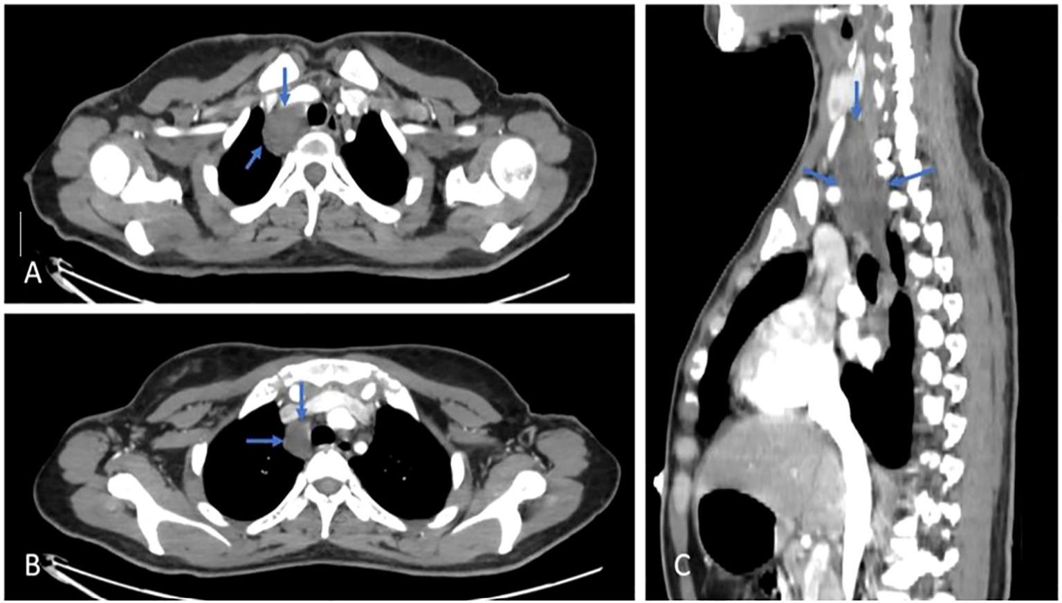 CT scan images in three views: Panel A and B show axial views of the chest with arrows indicating a mass near the trachea. Panel C presents a sagittal view highlighting the same mass adjacent to the spine.