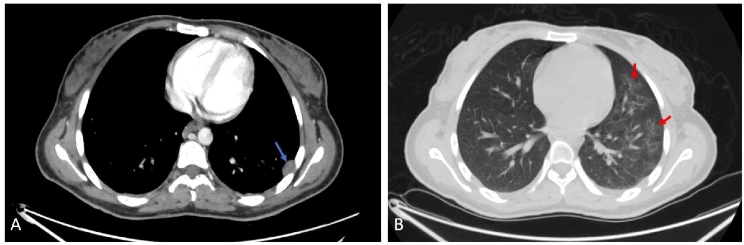 CT scan images showing two separate cross-sectional views of the chest. Image A has a blue arrow pointing to a feature on the right side, while Image B has two red arrows indicating areas on the left side. The images highlight differences in tissue density.