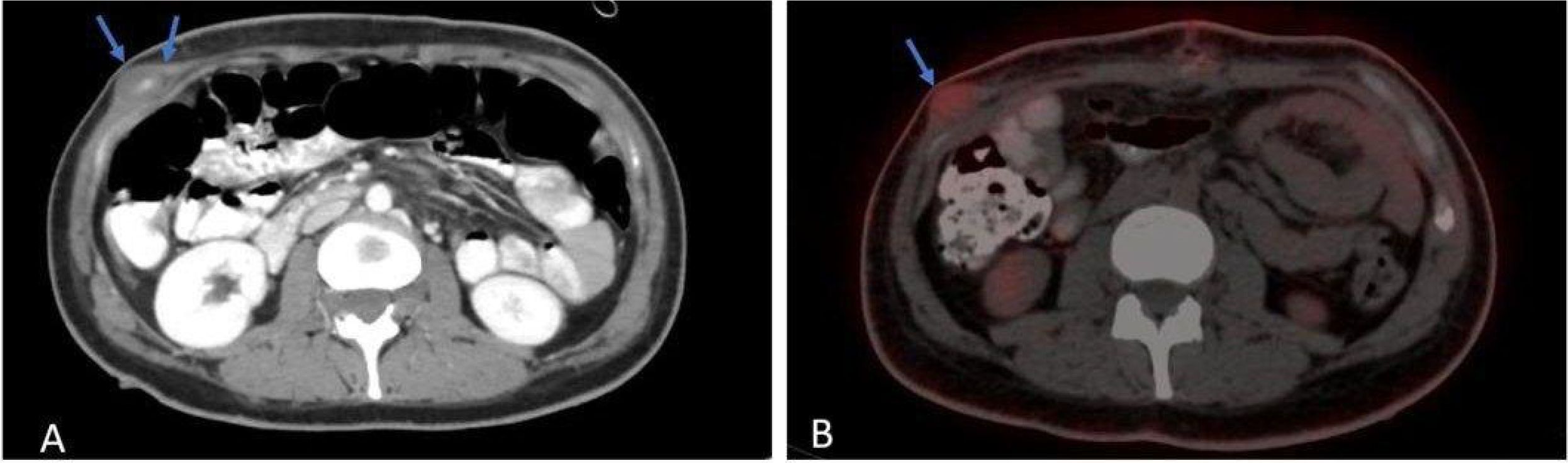 CT scans of the abdomen. Panel A shows an area with marked differences in tissue density, with blue arrows indicating the region of interest. Panel B, similar slice with slightly different contrast, also highlights the indicated region.
