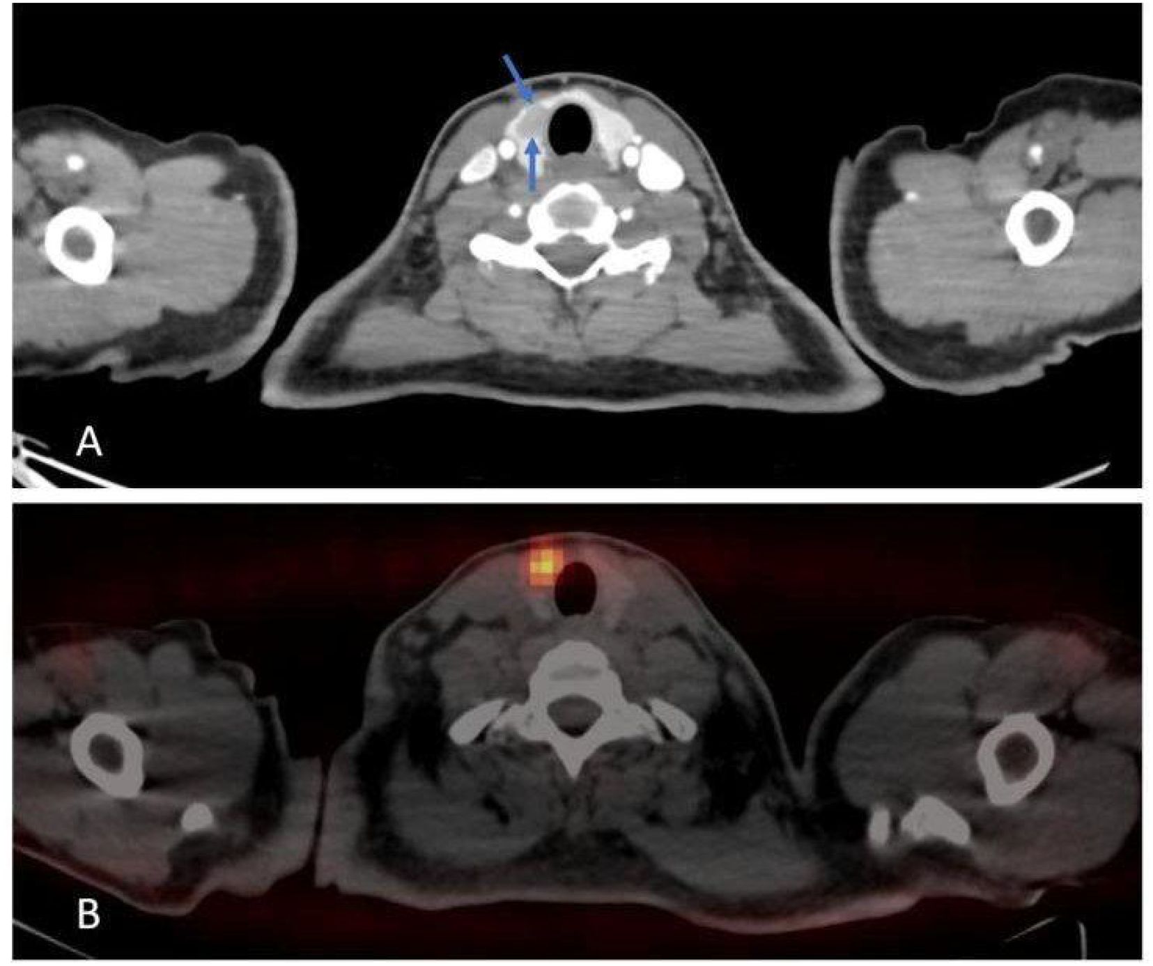 CT scans with two cross-sectional views of the neck area. Image A shows soft tissue density with two arrows pointing to specific areas. Image B includes a similar view with a highlighted area indicating increased metabolic activity.