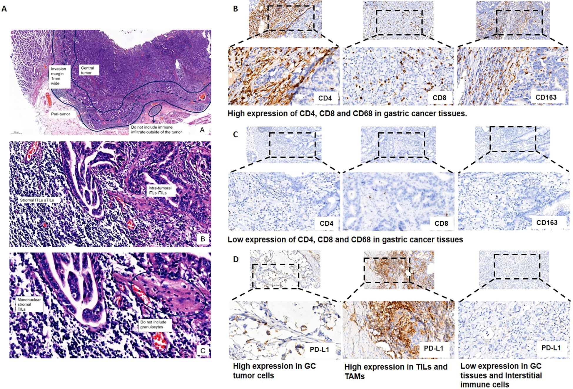 Histological images of gastric cancer tissues. Panel A shows tissue sections with labels indicating invasion margin, central tumor, and immune infiltration. Panel B illustrates high CD4, CD8, and CD68 expression. Panel C shows low expression of these markers. Panel D displays PD-L1 expression with high levels in tumor cells and tumor-associated macrophages, and low levels in interstitial immune cells.