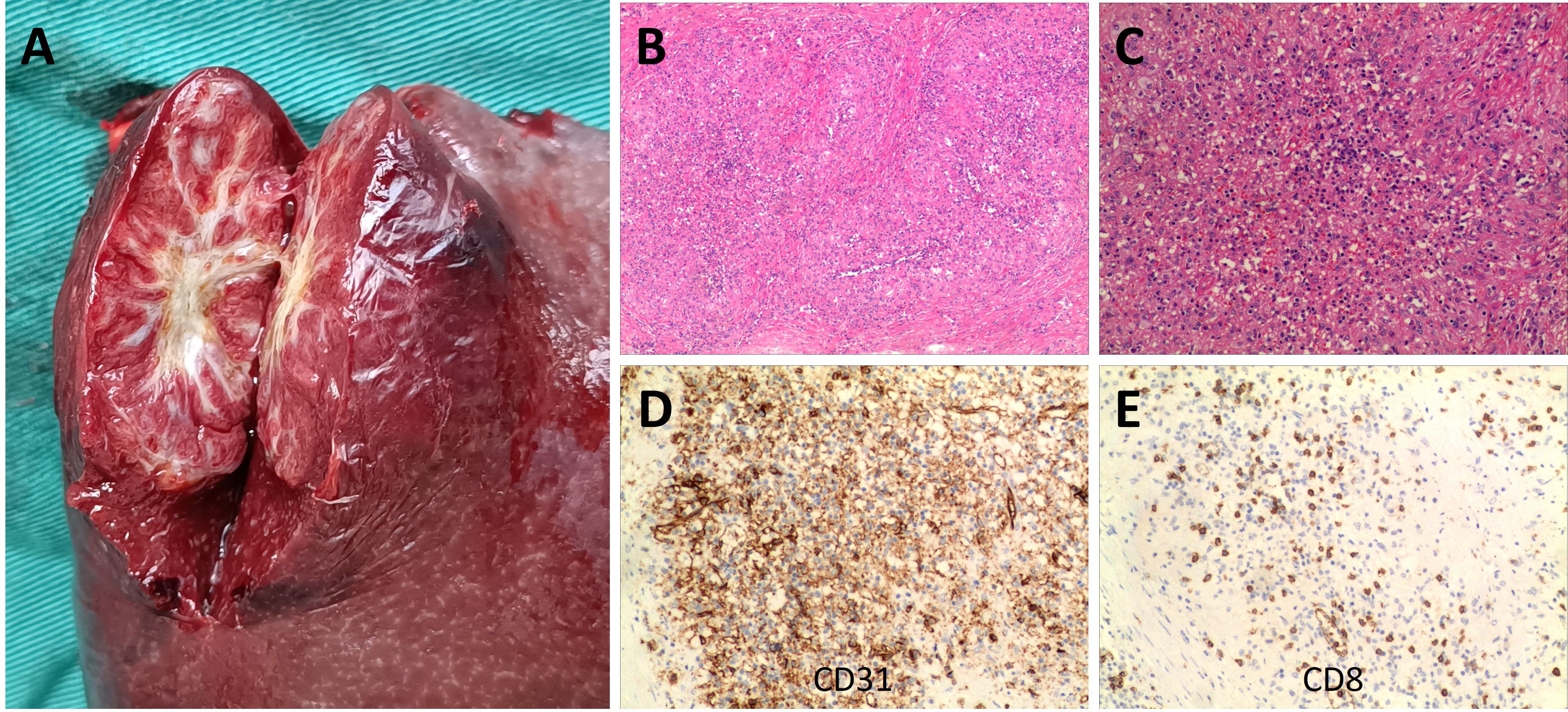 Five-panel medical image. Panel A shows a cross-section of a red, lobulated tissue against a green background. Panel B presents pink-stained tissue in a histological slide. Panel C features densely packed small circular structures in another slide. Panel D displays brown-stained tissue labeled “CD31,” indicating specific marker staining. Panel E shows scattered brown cells labeled “CD8,” suggesting another marker.