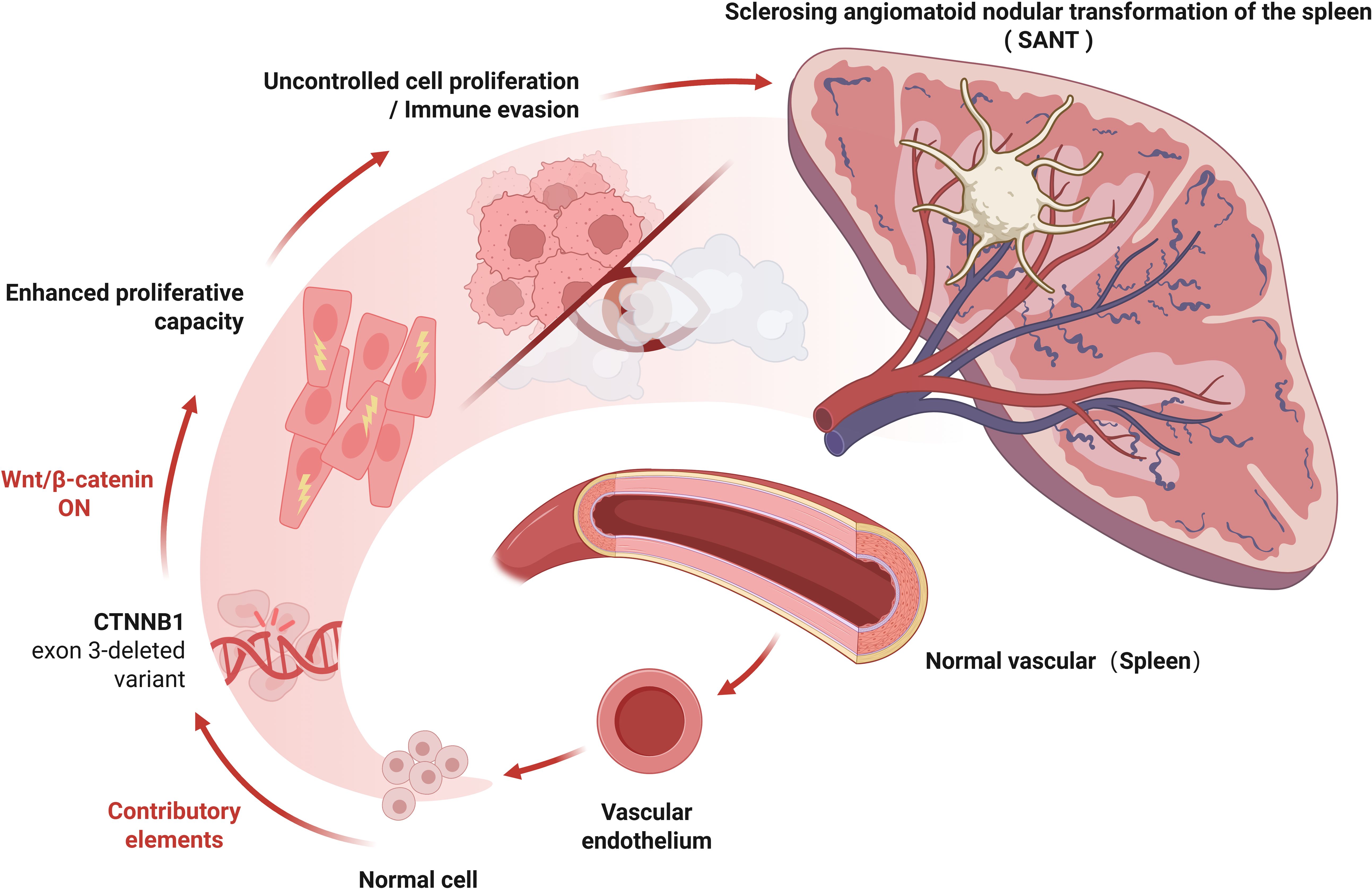 Schematic illustration of the proposed molecular mechanism underlying the development of sclerosing angiomatoid nodular transformation (SANT) of the spleen. The figure shows how CTNNB1 exon 3-deleted variants may lead to constitutive Wnt/β-catenin signaling activation, enhanced cellular proliferation, immune evasion, and ultimately contribute to the formation of SANT. Normal vascular endothelium evolves through a sequence of pathological changes, resulting in nodular, fibrosclerotic lesions in the spleen.