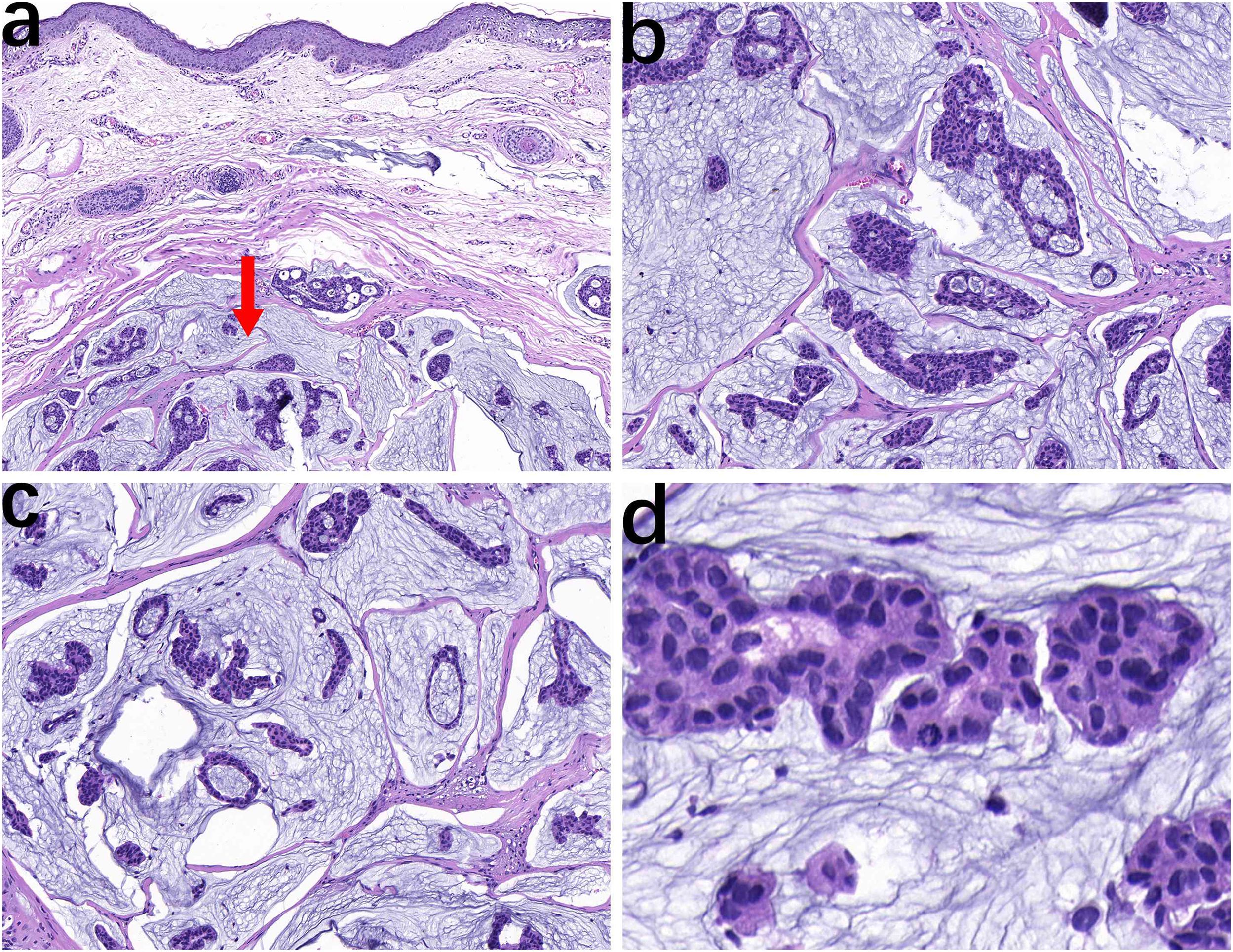 Histological sections of breast tissue stained with H&E. Panel a shows an overview with a red arrow highlighting a tumor. Panels b and c display closer views of invasive carcinoma with ductal patterns. Panel d provides a detailed view of the malignant cells with prominent nucleoli and high mitotic activity.