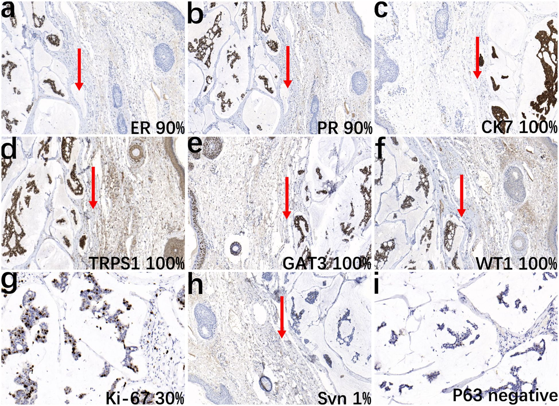 Histopathological immunohistochemistry of tissue samples, labeled a to i. Panels depict various markers: a) ER 90%, b) PR 90%, c) CK7 100%, d) TRPS1 100%, e) GATA3 100%, f) WT1 100%, g) Ki-67 30%, h) Syn 1%, i) P63 negative. Arrows indicate areas of interest with varied staining intensities across samples.
