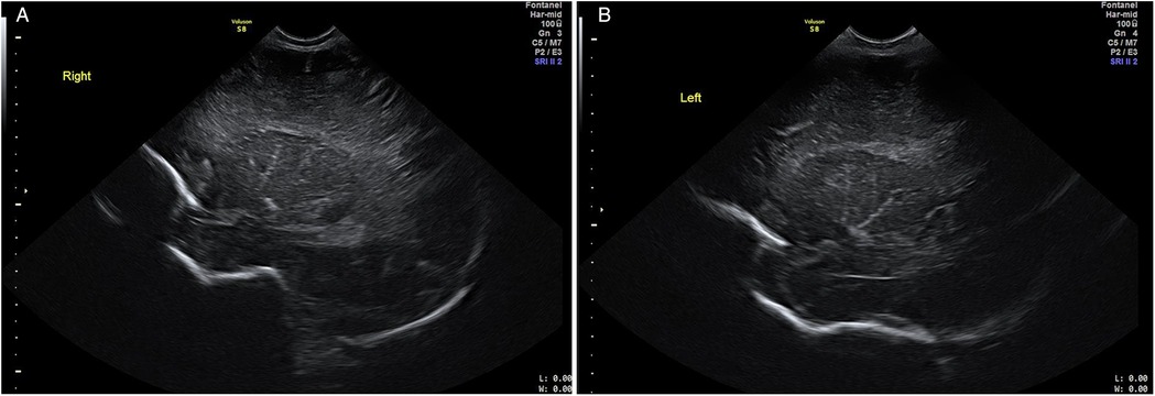 Neonatal cranial ultrasound 2D mode demonstrating bilateral hyperechoic branches of lenticulostriate vessels in parasagittal views.