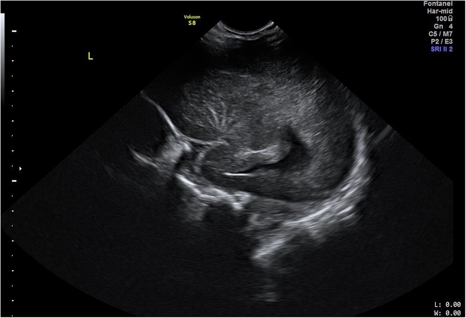Neonatal cranial ultrasound in 2D mode demonstrating unilateral multiple hyperechoic branches of lenticulostriate vessels in parasagittal view.