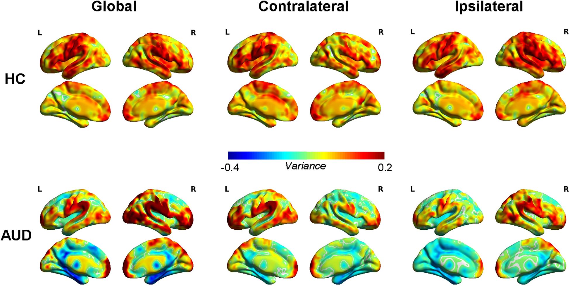 Brain variance maps compare two groups, HC (Healthy Controls) and AUD (Alcohol Use Disorder), across Global, Contralateral, and Ipsilateral models. The color scale ranges from blue (low variance) to red (high variance), highlighting differences in each group and condition, with clear variances observed especially in AUD.