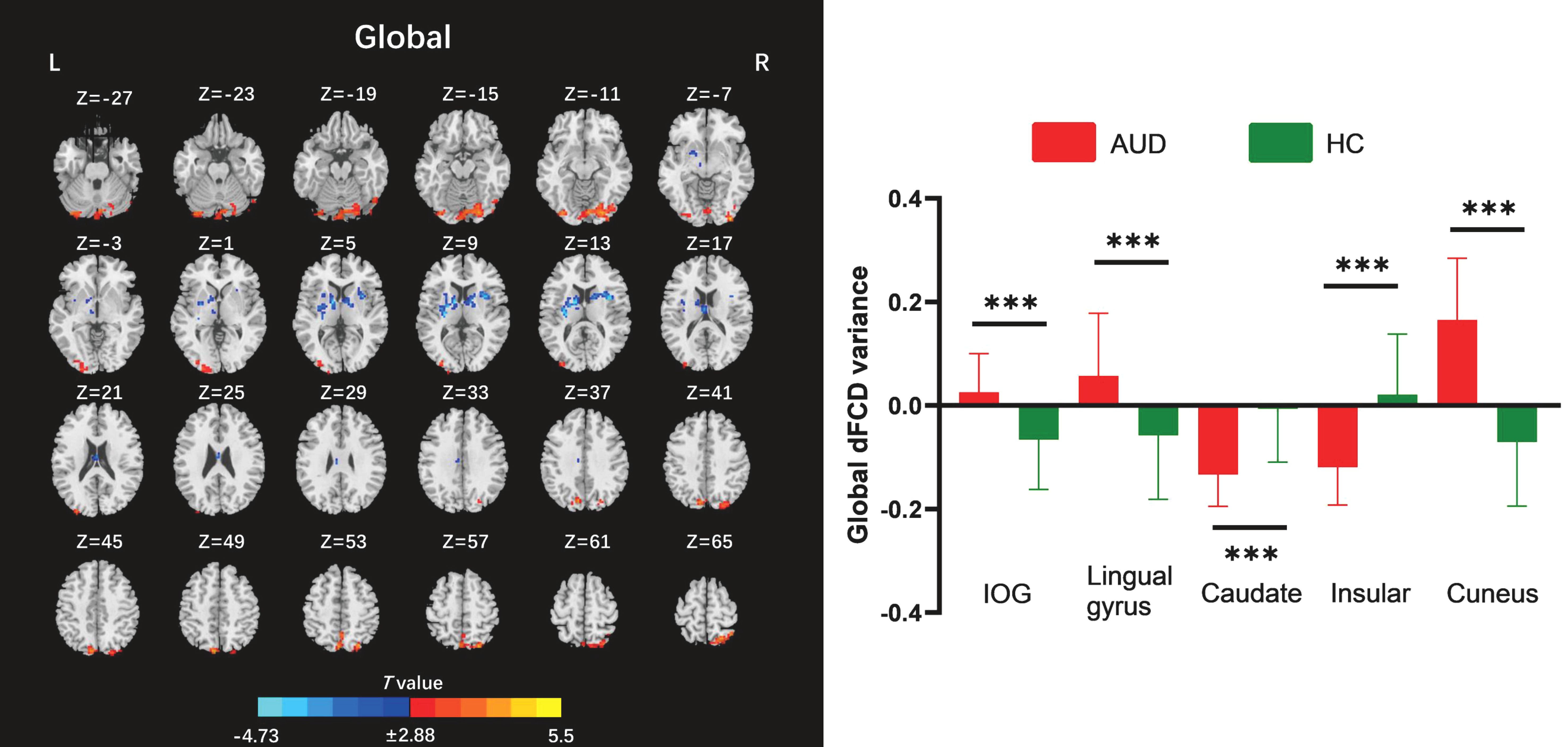 Brain scan images with various highlighted areas in blue and red, indicating different t-values across slices labeled with z-coordinates. Adjacent is a bar graph comparing global dFCD variance between AUD (red) and HC (green) across regions like IOG, lingual gyrus, caudate, insular, and cuneus, with statistical significance denoted by asterisks.