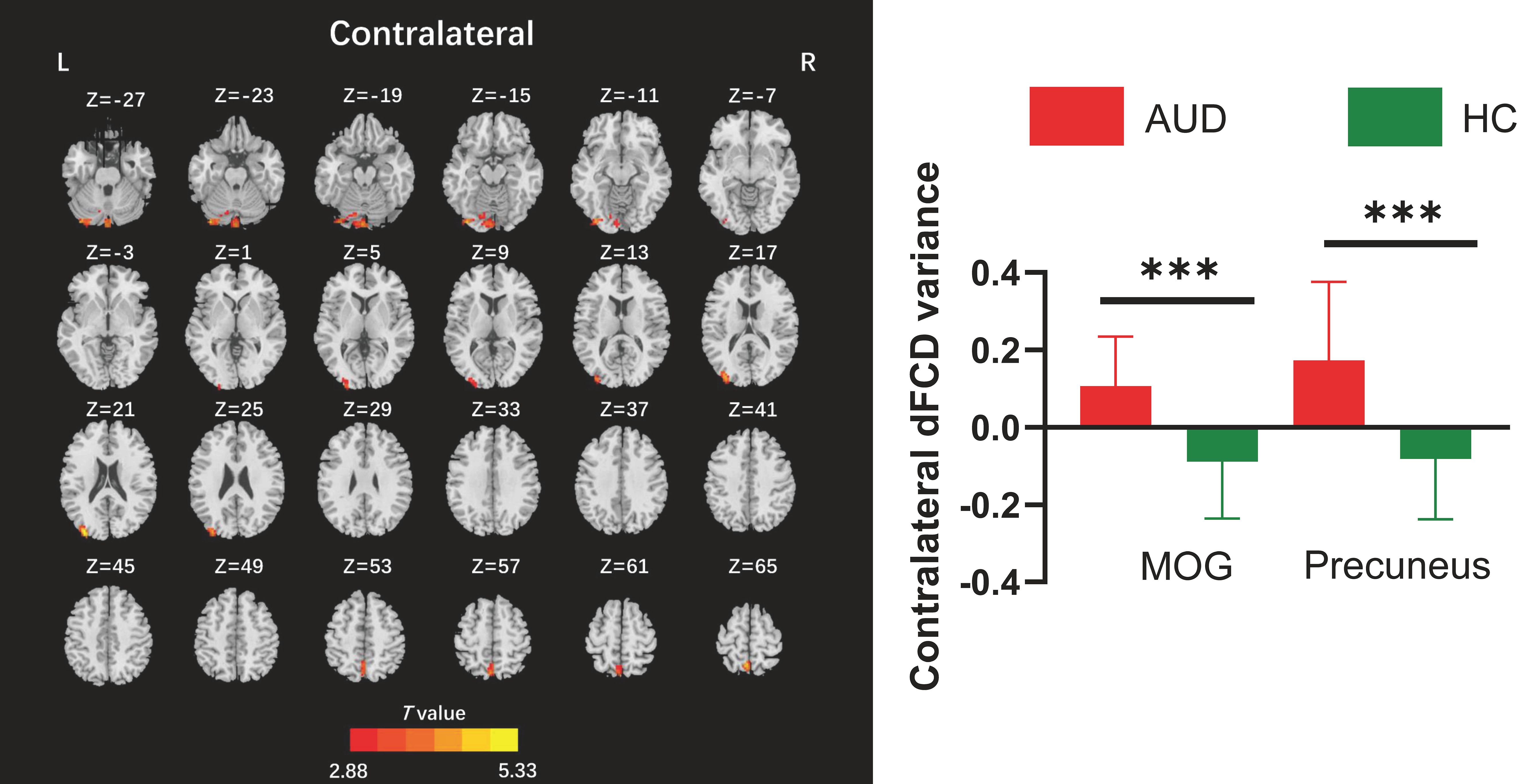 Brain imaging and graph showing contralateral activity. Left: Serial brain scans with highlighted areas in red indicating varying T values, ranging from two point eight eight to five point three three. Right: Bar graph comparing contralateral dFCD variance in AUD (red) and HC (green) participants, with significant differences in the middle occipital gyrus (MOG) and precuneus, indicated by three asterisks.