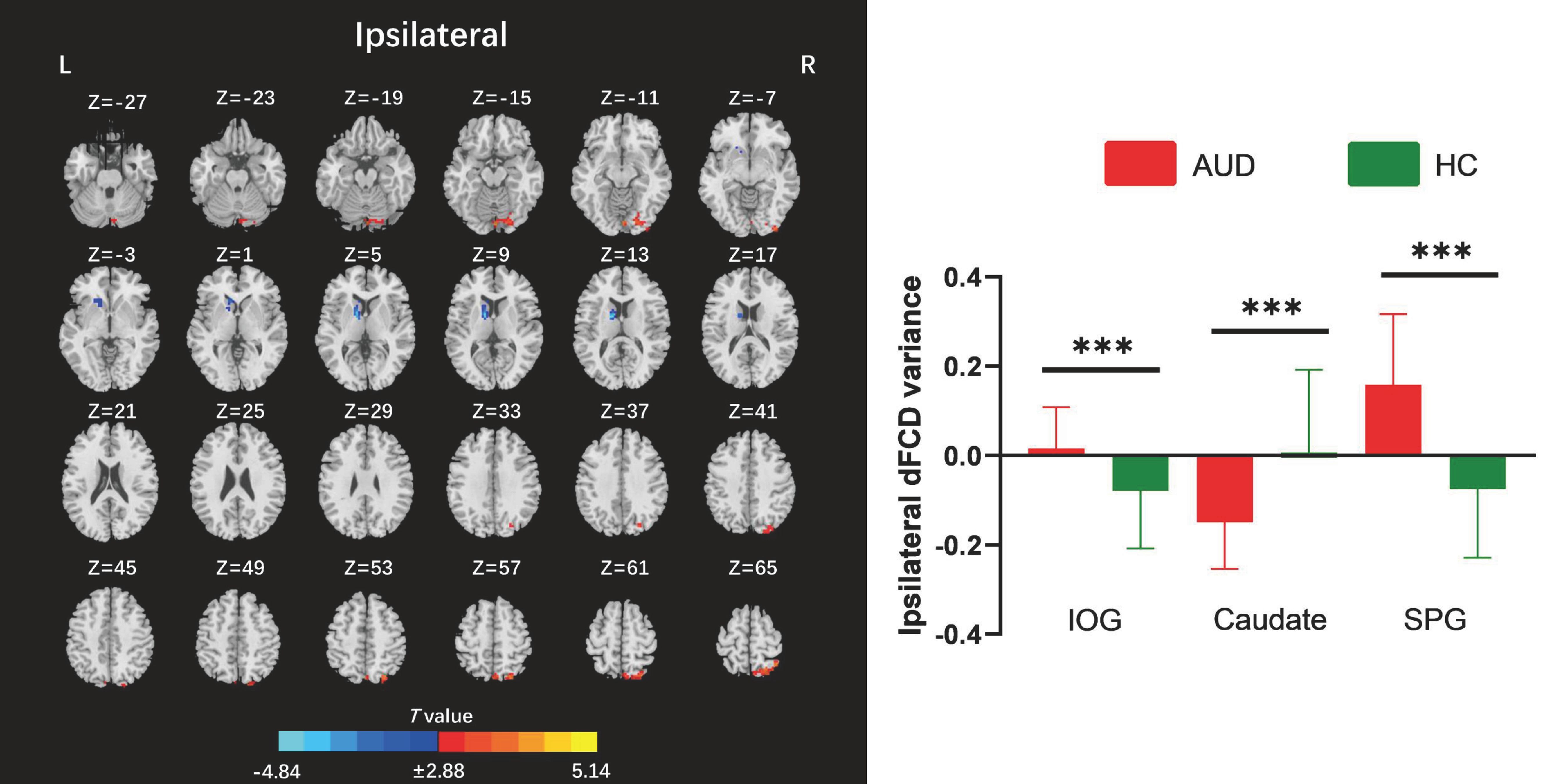 Brain scan images indicating ipsilateral regions at various Z coordinates, with a color bar showing T values from negative to positive. A bar graph on the right compares ipsilateral dFCD variance in AUD (red) and HC (green) groups across IOG, Caudate, and SPG regions, with significant differences marked by asterisks.