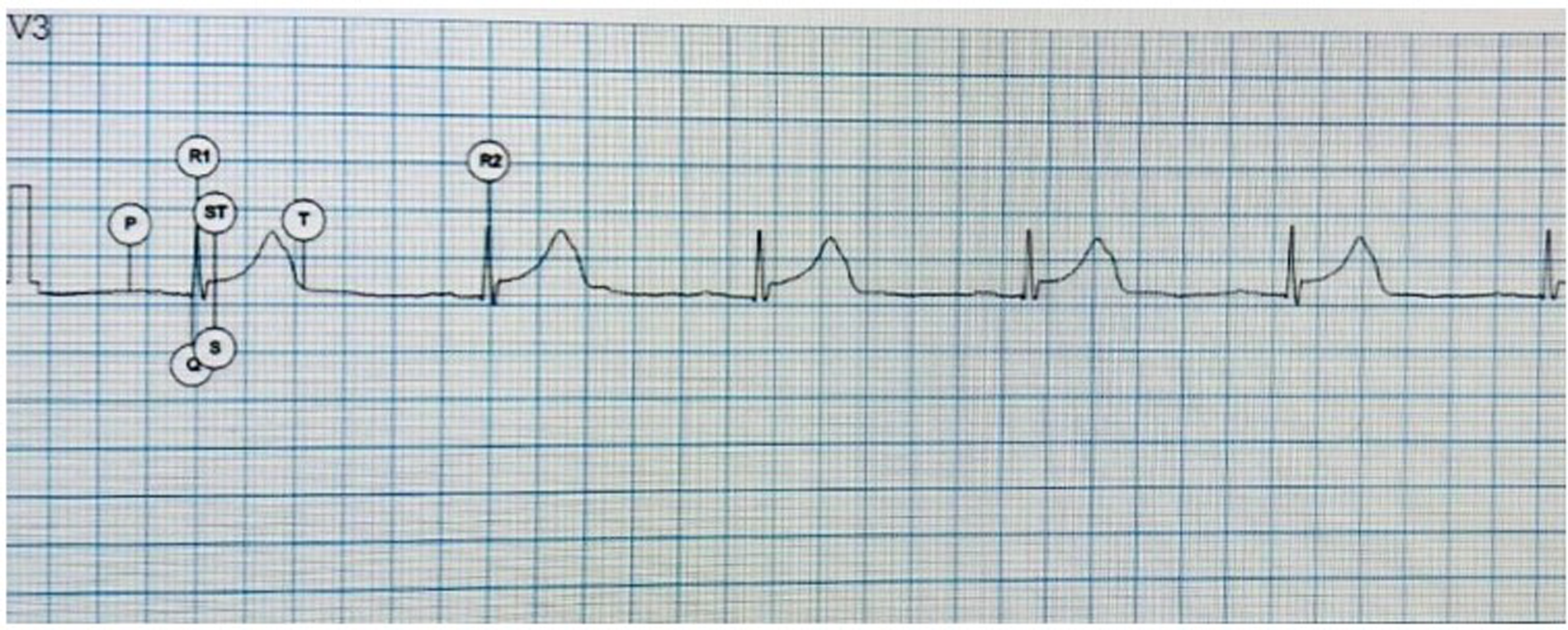 Electrocardiogram (ECG) graph showing a series of heartbeats with labeled waves and intervals. The P wave, QRS complex, and T wave are marked, along with intervals like ST and R peaks, plotted on grid paper.