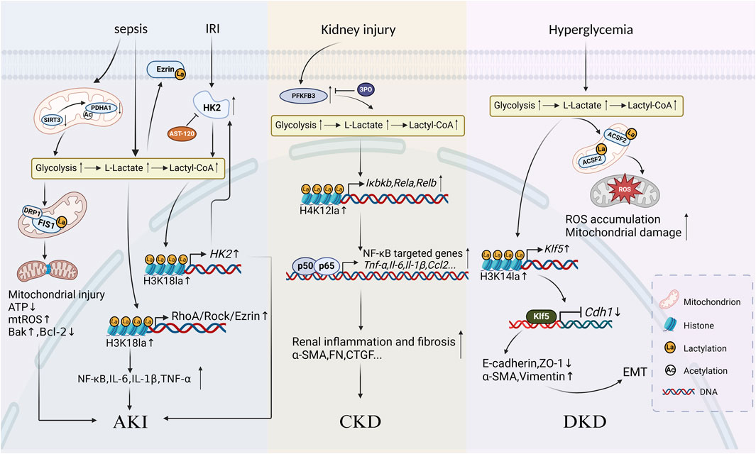 Diagram showing the role of lactylation in kidney injuries. It illustrates three pathways: AKI from sepsis and IRI increasing glycolysis, leading to mitochondrial injury; CKD from kidney injury, affecting NF-kB genes, causing inflammation and fibrosis; DKD from hyperglycemia causing ROS accumulation, damaging mitochondria, and triggering EMT. Symbols indicate mitochondria, histone lactylation, acetylation, and DNA.